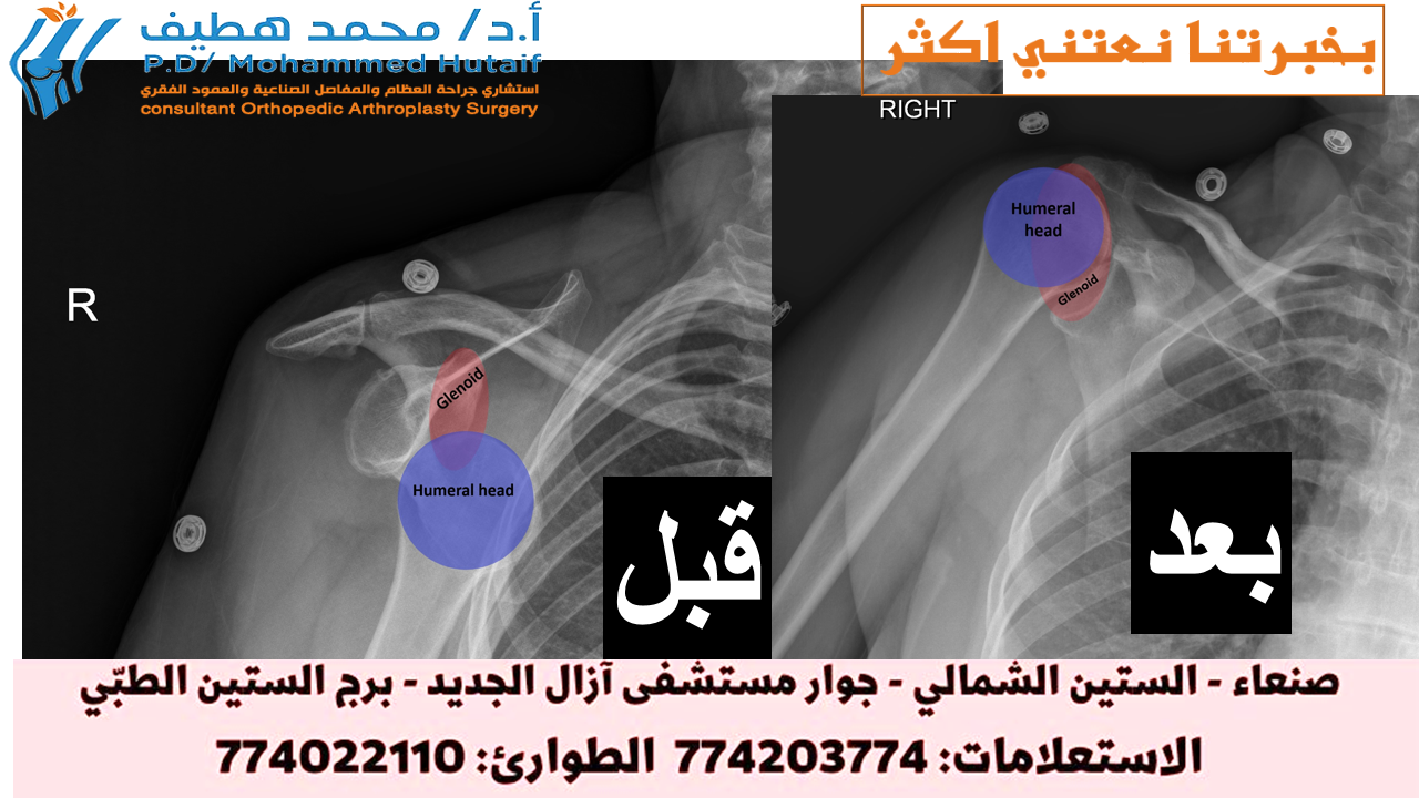 خلع الكتف -العلاج ماذا تفعل عند الإصابة بخلع في الكتف اذهب إلى  أقرب قسم للحوادث والطوارئ على الفور إذا كنت تعتقد أنك قد أصبت بخلع في كتفك.  أثناء انتظارك للعناية الطبية: لا تحرك المفصل. جبيرة أو حمالة مفصل الكتف في وضعه الحالي.  لا تحاول تحريك الكتف أو إجباره على العودة إلى مكانه. يمكن أن يؤدي ذلك إلى تلف مفصل الكتف والعضلات أو الأربطة أو الأعصاب أو الأوعية الدموية المحيطة به. ضع ثلجًا على المفصل المصاب. يمكن أن يساعد وضع الثلج على كتفك في تقليل الألم والتورم عن طريق التحكم في النزيف الداخلي وتراكم السوائل في مفصل الكتف وحوله.  كيف يتم علاج خلع الكتف سيتم تقييمك وفحصك عندما تصل إلى الطوارئ. ستخضع عادةً  للأشعة السينية  للتحقق مما إذا كنت قد كسرت أي عظام وتأكيد الخلع.  إذا كان لديك كسر ، فقد يكون لديك المزيد من الفحوصات لفحص المنطقة بمزيد من التفاصيل. تتطلب الكسور المصاحبة لخلع الكتف رعاية عظام متخصصة ، وقد تحتاج إلى جراحة.  إذا لم يكن لديك أي كسور ، فسيتم إعادة ذراعك بلطف مرة أخرى إلى مفصل الكتف باستخدام إجراء يعرف باسم التخفيض. الإرجاع  الإرجاع ستحصل على مسكنات للألم وقد يُعرض عليك دواء لمساعدتك على الاسترخاء (مهدئ).  عادة ما يتم إجراء الإرجاع في الطوارئ ، ولكن في بعض الأحيان يتم إجراؤه في غرفة العمليات تحت  التخدير العام بواسطة فريق تقويم العظام.  أثناء جلوسك على السرير ، يقوم الطبيب بتدوير ذراعك حول مفصل الكتف حتى يعود إلى مكانه. قد يستغرق هذا بضع دقائق.  سيكون لديك عادة أشعة سينية أخرى للتحقق من أن كتفك في الموضع الصحيح بمجرد عودة مفصل الكتف إلى مكانه.  إصلاح التمزقات في أنسجة الكتف يمزق بعض الأشخاص الأربطة والأوتار والأنسجة الأخرى عند خلع الكتف.  إذا تعرضت هذه الأنسجة للتلف ، فقد تحتاج إلى جراحة لإصلاحها. هذا يمكن أن يقلل بشكل كبير من فرصة خلع الكتف نفسه مرة أخرى في المستقبل لبعض الناس.  يتم إجراء الجراحة لإصلاح أنسجة الكتف تحت التخدير العام. يتم إجراؤها غالبًا باستخدام جراحة المنظار ، حيث يتم استخدام جروح صغيرة وأنبوب رفيع مزود بمصباح وكاميرا في أحد طرفيه (منظار المفصل) .  في بعض الأحيان يكون من الضروري إجراء عملية جراحية مفتوحة لتحريك العظام حول الكتف لمنع حدوث المزيد من الاضطرابات.  يمكن في بعض الأحيان تجنب الجراحة عن طريق القيام بتمارين مناسبة لتقوية الكتف إذا كانت الأنسجة مفرطة في التمدد ولكن لم تتمزق.  يتعافى من خلع في الكتف يمكنك عادةً العودة إلى المنزل بعد فترة وجيزة من إعادة كتفك إلى مكانه ، لكنك ستحتاج إلى إراحة ذراعك في حبال لبضعة أيام حتى يستقر الألم.  قد تحتاج إلى العودة إلى المستشفى لمتابعة الرعاية ، وقد تتم إحالتك أيضًا  للعلاج الطبيعي  لإعادة تأهيل كتفك وتقويتها.  تمارين الذراع والكتف قد يُنصح ببعض تمارين الذراع والكتف اللطيفة لممارستها في المنزل مع إخراج ذراعك من حبالها.  هذه سوف تساعد:  تقليل التيبس يخفف بعض الآلام بناء القوة في عضلات كتفك من المحتمل أن تشعر ببعض الألم أو عدم الراحة أو التمدد عند القيام بهذه التمارين. ومع ذلك ، إذا كنت تعاني من ألم شديد لأكثر من 30 دقيقة ، فقم بالتمرين بقوة أقل وبتكرار أقل.  مزيل للالم قد يكون كتفك مؤلمًا جدًا خلال الأيام القليلة الأولى في المنزل وقد تحتاج إلى تناول مسكنات الألم ، مثل الباراسيتامول أو الإيبوبروفين . اتبع دائمًا تعليمات الجرعة الموجودة على العبوة.  إذا لم يتحكم هذا في الألم ، يمكن أن يصف لك طبيبك مسكنًا أقوى للألم ، مثل الكوديين . يجب أن يهدأ الألم سريعًا إلى حد ما بمجرد إزالة القاذفة والبدء في تحريك كتفك.  وقت الانتعاش يمكنك التوقف عن ارتداء القاذفة بعد بضعة أيام ، لكن الأمر يستغرق حوالي 12 إلى 16 أسبوعًا للتعافي تمامًا من خلع الكتف.  ستتمكن عادةً من استئناف معظم الأنشطة في غضون أسبوعين ، ولكن يجب تجنب رفع الأثقال والرياضات التي تتضمن حركات الكتف لمدة تتراوح بين 6 أسابيع و 3 أشهر. سيقوم فريق الرعاية الخاص بك بتقديم المشورة لك.  من المحتمل أن تكون متوقفًا عن العمل لمدة 2 إلى 4 أسابيع ، أو أكثر ، إذا كان لديك عمل بدني. ناقش هذا مع فريق رعايتك.  إذا كنت قد كسرت ذراعك أو مفصل الكتف أيضًا ، فقد تحتاج إلى ارتداء المعلاق لمدة تصل إلى 6 أسابيع وسيستغرق التعافي وقتًا أطول.  خلع كتفك مرة أخرى تعتمد فرص خلع الكتف مرة أخرى على عمرك ومدى شفاء الأنسجة المحيطة بالمفصل في المرة الأولى.  يمكن أن يساعد إذا تم إصلاح أي أنسجة ممزقة جراحيًا بعد إعادة الكتف المخلوع إلى مكانه.  ومع ذلك ، تحدث الاضطرابات اللاحقة في بعض الأحيان ، خاصة عند الأشخاص الذين تقل أعمارهم عن 25 عامًا والذين تزيد أعمارهم عن 40 عامًا.  يمكن أن يؤدي القيام بتمارين التعافي بانتظام تحت إشراف أخصائي العلاج الطبيعي وتجنب وضعيات الذراع المحرجة إلى تقليل خطر حدوث خلع في الكتف مرة أخرى.  آخر مراجعة للصفحة: 21 يناير 2020 موعد المراجعة التالي: 21 يناير