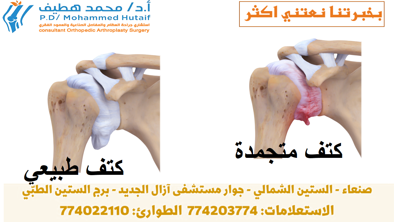  الكتف المتجمد  ملخص الكتف المتجمد ، ويسمى أيضًا التهاب المحفظة اللاصق ، يسبب ألمًا وتيبسًا في الكتف. بمرور الوقت ، يصبح من الصعب جدًا تحريك الكتف.  بعد فترة من تفاقم الأعراض ، يميل الكتف المتجمد إلى التحسن ، على الرغم من أن الشفاء التام قد يستغرق ما يصل إلى 3 سنوات. العلاج الطبيعي ، مع التركيز على مرونة الكتف ، هو العلاج الأساسي للكتف المتجمدة.  يصيب الكتف المتجمد بشكل شائع الأشخاص الذين تتراوح أعمارهم بين 40 و 60 عامًا ، ويحدث عند النساء أكثر من الرجال. بالإضافة إلى ذلك ، يتعرض مرضى السكري لخطر الإصابة بتجمد الكتف.  تزداد خطورة الإصابة بالكتف المتجمدة ما إذا كنت تتماثل للشفاء من إجراء أو حالة طبية تمنعك من تحريك ذراعك، كالسكتة الدماغية أو استئصال الثدي. الوسائط ذات الصلة تمارين تأهيل الكفة والكتف يتضمن علاج الكتف المتجمدة تمارين مدى الحركة وأحيانًا ما يتضمن الكورتيكوستيرويدات وأدوية مخدرة يتم حقنها بالمحفظة المفصلية. في نسبة صغيرة من الحالات يمكن الإشارة إلى جراحة تنظير المفصل لإرخاء المحفظة المفصلية حتى تتمكن من الحركة بحرية أكبر.  من غير الطبيعي معاودة الإصابة بالكتف المتجمدة في نفس الكتف، ولكن يمكن إصابة بعض الأشخاص في الكتف الأخرى. في هذه النشرة الكتف المتجمد- ملخص الصفحة التالية: تشريح الكتف تشريح كتفك عبارة عن مفصل كروي ومقبس يتكون من ثلاثة عظام: عظم الذراع العلوي (عظم العضد) وكتفك (الكتف) وعظم الترقوة (الترقوة).  يتناسب رأس عظم العضد مع تجويف ضحل في لوح الكتف. نسيج ضام قوي ، يسمى كبسولة الكتف ، يحيط بالمفصل.  لمساعدة كتفك على التحرك بسهولة أكبر ، يقوم السائل الزليلي بتشحيم كبسولة الكتف والمفصل.  تشريح الكتف تحيط كبسولة الكتف بمفصل الكتف وأوتار الكفة المدورة. مستنسخة ومعدلة من تقويم الجسم. (ج) الأكاديمية الأمريكية لجراحي العظام ، 2003. وصف في الكتف المتجمد ، تزداد سماكة كبسولة الكتف وتصبح صلبة ومشدودة. تتطور عصابات سميكة من الأنسجة - تسمى التصاقات. في كثير من الحالات ، يوجد سائل زليلي أقل في المفصل.  العلامات المميزة لهذه الحالة هي الألم الشديد وعدم القدرة على تحريك كتفك - إما بمفردك أو بمساعدة شخص آخر. يتطور على ثلاث مراحل:  المرحلة 1: التجميد في مرحلة 