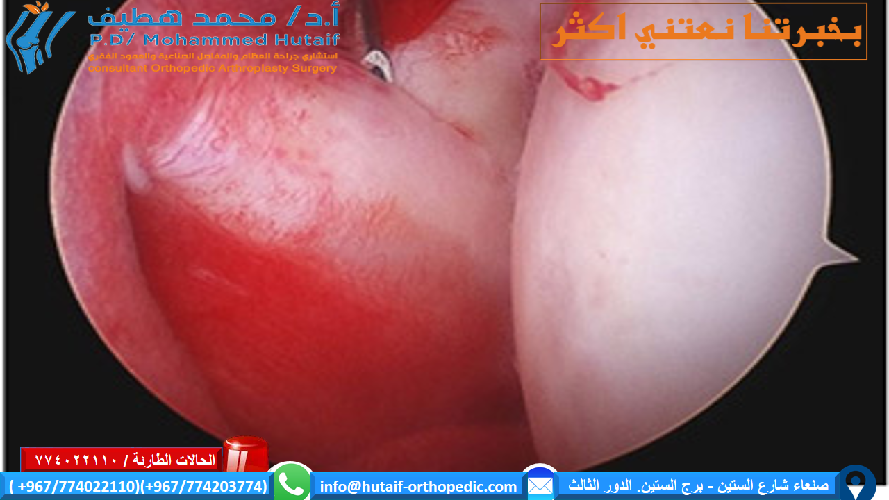  الكتف المتجمد  ملخص الكتف المتجمد ، ويسمى أيضًا التهاب المحفظة اللاصق ، يسبب ألمًا وتيبسًا في الكتف. بمرور الوقت ، يصبح من الصعب جدًا تحريك الكتف.  بعد فترة من تفاقم الأعراض ، يميل الكتف المتجمد إلى التحسن ، على الرغم من أن الشفاء التام قد يستغرق ما يصل إلى 3 سنوات. العلاج الطبيعي ، مع التركيز على مرونة الكتف ، هو العلاج الأساسي للكتف المتجمدة.  يصيب الكتف المتجمد بشكل شائع الأشخاص الذين تتراوح أعمارهم بين 40 و 60 عامًا ، ويحدث عند النساء أكثر من الرجال. بالإضافة إلى ذلك ، يتعرض مرضى السكري لخطر الإصابة بتجمد الكتف.  تزداد خطورة الإصابة بالكتف المتجمدة ما إذا كنت تتماثل للشفاء من إجراء أو حالة طبية تمنعك من تحريك ذراعك، كالسكتة الدماغية أو استئصال الثدي. الوسائط ذات الصلة تمارين تأهيل الكفة والكتف يتضمن علاج الكتف المتجمدة تمارين مدى الحركة وأحيانًا ما يتضمن الكورتيكوستيرويدات وأدوية مخدرة يتم حقنها بالمحفظة المفصلية. في نسبة صغيرة من الحالات يمكن الإشارة إلى جراحة تنظير المفصل لإرخاء المحفظة المفصلية حتى تتمكن من الحركة بحرية أكبر.  من غير الطبيعي معاودة الإصابة بالكتف المتجمدة في نفس الكتف، ولكن يمكن إصابة بعض الأشخاص في الكتف الأخرى. في هذه النشرة الكتف المتجمد- ملخص الصفحة التالية: تشريح الكتف تشريح -الكتف المتجمد كتفك عبارة عن مفصل كروي ومقبس يتكون من ثلاثة عظام: عظم الذراع العلوي (عظم العضد) وكتفك (اللوح) وعظم الترقوة   يتناسب رأس عظم العضد مع تجويف ضحل في لوح الكتف. هناك نسيج ضام قوي ، يسمى كبسولة الكتف ، يحيط بالمفصل. في هذه النشرة الكتف المتجمد- ملخص تشريح -الكتف المتجمد وصف الكتف المتجمد لمساعدة كتفك على التحرك بسهولة أكبر ، يقوم السائل الزليلي بتشحيم كبسولة الكتف والمفصل.  تشريح الكتف تحيط كبسولة الكتف بمفصل الكتف وأوتار الكفة المدورة. تحدث الإصابة بالكتف المتجمدة عندما تصبح الأنسجة الضامة التي تُغلف المفاصل سميكة ومشدودة.  الوسائط ذات الصلة تمارين تأهيل الكفة والكتف  الصفحة التالية: وصف الكتف المتجمد  وصف الكتف المتجمد في الكتف المتجمد ، تزداد سماكة كبسولة الكتف وتصبح صلبة ومشدودة. تتطور عصابات سميكة من الأنسجة - تسمى التصاقات. في كثير من الحالات ، يوجد سائل زليلي أقل في المفصل.  العلامات المميزة لهذه الحالة هي الألم الشديد وعدم القدرة على تحريك كتفك - إما بمفردك أو بمساعدة شخص آخر. يتطور على ثلاث مراحل:  مرحلة التجميد  في مرحلة 