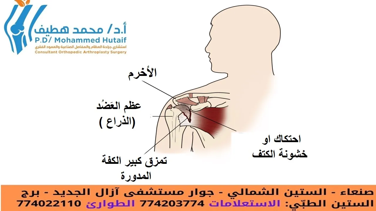 التهاب مفاصل الكتف احتكاك مفاصل الكتف خشونة مفاصل الكتف ملخص   كل عام ، يتم تشخيص ملايين الأشخاص حول العالم بأحد أشكال التهاب المفاصل. يُعرف التهاب المفاصل ببساطة بأنه التهاب في مفصل أو أكثر من مفاصلك. في الكتف المصاب ، يسبب هذا الالتهاب ألمًا وتيبسًا يمكن أن يجعل من الصعب رفع ذراعك أو تمشيط شعرك أو الوصول إلى رف مرتفع. على الرغم من عدم وجود علاج شافٍ لالتهاب مفاصل الكتف ، إلا أن هناك العديد من خيارات العلاج المتاحة. بحيث، يمكن لمعظم الأشخاص المصابين بالتهاب المفاصل التحكم في الألم والبقاء نشيطين.     تشريح   كتفك مكونة من ثلاث عظام:   عظم العَضُد  (الذراع ) عظم اللَّوْح أو لوح الكتف  الترقوة  يتناسب رأس عظمة الجزء العلوي من ذراعك مع تجويف دائري في كتفك. هذا التجويف يسمى الحقاني. مجموعة من العضلات والأوتار تحافظ على مركز عظم ذراعك في تجويف الكتف. تسمى هذه أنسجة الكفة المدورة.   يوجد مفصلان في الكتف وقد يتأثر كلاهما بالتهاب المفاصل. يوجد مفصل حيث تلتقي الترقوة بطرف لوح الكتف (الأخرم). وهذا ما يسمى المفصل الأخرمي الترقوي (AC). والثاني هو مكان وضع رأس عظم العضد في لوح الكتف ويسمى المفصل الحقاني العضدي.      رسم توضيحي لتشريح الكتف الطبيعي   العلاج الفعال، يستلزم تحديد المفصل المصاب ونوع التهاب المفاصل الذي تعاني منه.   وصف خمسة أنواع رئيسية من التهاب المفاصل تؤثر عادة على الكتف.   احتكاك او خشونة العظام يُعرف أيضًا باسم التهاب المفاصل "التآكل والتلف" ، وهو حالة تؤدي إلى تدمير الغطاء الخارجي الأملس (الغضروف المفصلي) للعظام. مع تآكل الغضروف المفصلي ، يصبح مهترئًا وخشنًا ، وتقل المساحة الواقية بين العظام.  أثناء الحركة ، تحتك عظام المفصل ببعضها البعض ، مما يسبب الألم.  غالبًا ما يشار إلى هذا باسم التهاب المفاصل او احتكاك او خشونة العظام "العظم على العظم".   عادةً ما يصيب احتكاك او خشونة العظام الأشخاص الذين تزيد أعمارهم عن 50 عامًا وهو أكثر شيوعًا في المفصل الأخرمي الترقوي منه في مفصل الكتف الحقاني العضدي.        رسم توضيحي وأشعة سينية يظهران احتكاك او خشونة العظام في الكتف وانخفاض مساحة المفصل     التهاب المفاصل الرثوي (الروماتويدي) والتهاب المفاصل الرثوي هو حالة مزمنة تصيب المفاصل على جانبي الجسم، فيصيب مثلًا كلتا اليدين أو المعصمين و/أو الركبتين. وتتميز هذه الحالة عن غيرها من أنواع التهاب المفاصل الأخرى بتعدد وتناسق التهاب المفاصل بهذه الطريقة. تُغطى مفاصل جسمك ببطانة - تسمى الغشاء الزليلي - تعمل على تليين المفصل وتسهيل حركته. يتسبب التهاب المفاصل الروماتويدي في انتفاخ البطانة ، مما يسبب ألمًا وتيبسًا في المفصل. ولا يقتصر التهاب المفاصل الرثوي على المفاصل وحسب، فأحيانًا يمكن أن يصيب أعضاء الجسم الُأخرى كالجلد والعينين والرئتين والقلب والدم والأعصاب والكليتين. التهاب المفاصل الروماتويدي هو أحد أمراض المناعة الذاتية. هذا يعني أن الجهاز المناعي يهاجم أنسجته. في التهاب المفاصل الروماتويدي ، تعمل الدفاعات التي تحمي الجسم من العدوى على إتلاف الأنسجة الطبيعية (مثل الغضاريف والأربطة) وتليين العظام. التهاب المفاصل الروماتويدي شائع أيضًا في كلا مفصلي الكتف. التهاب المفاصل ما بعد الصدمة التهاب المفاصل ما بعد الصدمة هو شكل من أشكال هشاشة العظام الذي يتطور بعد الإصابة ، مثل كسر أو خلع في الكتف.   تمزق الكُفَّة المُدَوِّرَة أو الكُفَّة المديرة يمكن أن يتطور التهاب المفاصل أيضًا بعد تمزق وتر الكفة المدورة. اذ لم يعد بإمكان الكفة المدورة الممزقة تثبيت رأس عظم العضد في التجويف الحقاني، ويمكن لعظم العضد أن يتحرك لأعلى ويحتك مع الأخرم. يمكن أن يؤدي ذلك إلى إتلاف أسطح العظام ، مما يؤدي إلى الإصابة بالتهاب مفاصل الكتف او احتكاك مفاصل الكتف  اوخشونة مفاصل الكتف   يمكن أن يؤدي الجمع بين تمزق الكفة المدورة الكبير والتهاب المفاصل المتقدم إلى ألم شديد وضعف ، وقد لا يتمكن المريض من رفع ذراعه.        رسم توضيحي لاعتلال مفاصل الكفة المدورة     مرض نقصان الدم المزود للعظام (النخر اللاوعائي) النخر اللاوعائي (AVN) للكتف هو حالة مؤلمة تحدث عندما ينقطع تدفق الدم إلى رأس عظم العضد. لأن الخلايا العظمية تموت دون إمداد الدم ، يمكن أن يؤدي مرض نقصان الدم المزود للعظام (النخر اللاوعائي)في النهاية إلى تدمير مفصل الكتف.   يتطور النخر اللاوعائي على مراحل. مع تقدمه ، ينهار العظم الميت تدريجيًا ، مما يؤدي إلى إتلاف الغضروف المفصلي الذي يغطي العظم ويؤدي إلى التهاب المفاصل. في البداية ، يؤثر مرض نقصان الدم المزود للعظام (النخر اللاوعائي)فقط على رأس عظم العضد ، ولكن مع تقدم مرض نقصان الدم المزود للعظام (النخر اللاوعائي)، يمكن أن يتسبب رأس عظم العضد المنهار في إتلاف التجويف الحقاني.   تشمل أسباب مرض نقصان الدم المزود للعظام (النخر اللاوعائي)استخدام جرعات عالية من الستيرويد ، والإفراط في استهلاك الكحول ، ومرض الخلايا المنجلية ، والإصابات الرضحية ، مثل كسور الكتف. في بعض الحالات ، لا يمكن تحديد سبب ؛ يشار إلى هذا باسم مرض نقصان الدم المزود للعظام (النخر اللاوعائي)مجهول السبب.   أعراض الم. أكثر أعراض التهاب مفصل الكتف شيوعًا هو الألم. يتفاقم هذا الألم بسبب النشاط ويزداد سوءًا بمرور الوقت. يختلف مكان الألم ، اعتمادًا على مفصل الكتف المصاب:   إذا تأثر مفصل الكتف الحقاني العضدي ، يتركز الألم في جانب أو مؤخرة الكتف وقد يتفاقم مع التغيرات في الطقس. يشكو المرضى من وجع عميق في المفصل. يتركز ألم التهاب المفاصل في المفصل الأخرمي الترقوي على الجزء العلوي من الكتف. يمكن أن ينتقل هذا الألم أحيانًا أو ينتقل إلى جانب الرقبة. قد يعاني الشخص المصاب بالتهاب المفاصل الروماتويدي من ألم في جميع أنحاء الكتف إذا تأثر كل من المفصل الحقاني العضدي والمفصل الأخرمي الترقوي (AC).. مع تقدم المرض ، فإن أي حركة للكتف تسبب الألم. الألم الليلي شائع ، وقد يكون النوم صعبًا.   قد تشمل الأعراض الأخرى:   نطاق محدود من الحركة. تعد الحركة المحدودة من الأعراض الشائعة الأخرى. قد يصبح رفع ذراعك أكثر صعوبة لتمشيط شعرك أو الوصول إلى الرف.    قد تسمع صوت طحن أو نقر أو فرقعة أثناء تحريك كتفك. أحيانًا يكون صوت الفرقعة مؤلمًا ويمكن أن يكون مرتفعًا بما يكفي ليستمع إليه الآخرون ،   فحص الطبيب التاريخ الطبي والفحص البدني بعد مناقشة الأعراض والتاريخ الطبي ، سيفحص طبيبك كتفك.   أثناء الفحص البدني ، سيبحث طبيبك عن:   ضعف (ضمور) العضلات الم عند للمس مدى نطاق الحركة السلبي (المساعد) والنشط (الموجه ذاتيا) ألم عند الضغط على المفصل أي علامات إصابة في العضلات والأوتار والأربطة المحيطة بالمفصل علامات الإصابات أو العمليات الجراحية السابقة إصابة المفاصل الأخرى (دلالة على التهاب المفاصل الروماتويدي)   الأشعة السينية الأشعة السينية هي اختبارات تصوير تخلق صورًا مفصلة للهياكل الكثيفة ، مثل العظام. يمكنهم المساعدة في التمييز بين الأشكال المختلفة لالتهاب المفاصل.   ستظهر الأشعة السينية للكتف المصابة بالتهاب المفاصل تضيقًا في مساحة المفصل ، وتغيرات في العظام ، وتشكيل نتوءات عظمية (نبتات عظمية)       .   تُظهر هذه الأشعة السينية الإصابة بالتهاب الكتف او احتكاك الكتف اوخشونة  الكتف شديدة في المفصل الحقاني العضدي.        العلاج  العلاج غير الجراحي كما هو الحال مع حالات التهاب المفاصل الأخرى ، فإن العلاج الأولي لالتهاب مفاصل الكتف غير جراحي. قد يوصي طبيبك بما يلي:   الراحة أو التغيير في الأنشطة. قد تحتاج إلى تغيير طريقة تحريك ذراعك لتجنب إثارة الألم. قد تحسن تمارين العلاج الطبيعي نطاق الحركة في كتفك. قد تقلل العقاقير غير الستيرويدية المضادة للالتهابات (NSAIDs) ، مثل الأسبرين أو الأيبوبروفين أو النابروكسين ، الالتهاب والألم. يمكن أن تهيج هذه الأدوية بطانة المعدة وتسبب نزيفًا داخليًا. يجب تناولها مع الطعام.  استشر طبيبك قبل تناول مضادات الالتهاب غير الستيرويدية التي لا تستلزم وصفة طبية  يمكن لحقن الكورتيكوستيرويد في الكتف أن يقلل بشكل كبير من الالتهاب والألم. ومع ذلك ، فإن التأثير غالبًا ما يكون مؤقتًا.   قد توفر الحرارة الرطبة راحة مؤقتة. ضع الثلج على كتفك لمدة 20 إلى 30 دقيقة مرتين أو ثلاث مرات في اليوم لتقليل الالتهاب وتخفيف الألم. إذا كنت مصابًا بالتهاب المفاصل الروماتويدي ، فقد يصف لك طبيبك (اختصاصي أمراض الروماتيزم عادةً) دواءً معدلاً للمرض ، مثل الميثوتريكسات.   قد تساعد المكملات الغذائية ، مثل الجلوكوزامين وكبريتات شوندروتن في تخفيف الألم. (ملاحظة: هناك القليل من الأدلة العلمية لدعم استخدام الجلوكوزامين وكبريتات شوندروتن لعلاج التهاب المفاصل. بالإضافة إلى ذلك ، لا تختبر إدارة الغذاء والدواء الأمريكية المكملات الغذائية. قد تسبب هذه المركبات تفاعلات سلبية مع الأدوية الأخرى. استشر طبيبك دائمًا قبل تناول المكملات الغذائية.) العلاج الجراحي قد يفكر طبيبك في الجراحة إذا كان ألمك يسبب إعاقة ولم يتم تخفيفه بالعلاج غير الجراحي.   تنظير المفصل. يمكن علاج حالات التهاب المفاصل الحقاني العضدي الخفيف عن طريق تنظير المفصل ، أثناء تنظير المفاصل ، يقوم الطبيب بإدخال كاميرا صغيرة تسمى منظار المفصل في مفصل الكتف. تعرض الكاميرا الصور على شاشة فيديو ، ويستخدم الطبيب هذه الصور لتوجيه الأدوات الجراحية المصغرة.   نظرًا لأن منظار المفصل والأدوات الجراحية رفيعة ، يمكن للجراح استخدام شقوق صغيرة جدًا بدلاً من الشق الأكبر المطلوب لإجراء الجراحة القياسية المفتوحة.   أثناء الإجراء ، يمكن لطبيبك أن ينظف  الجزء الداخلي من المفصل. على الرغم من أن الإجراء يخفف الآلام ، إلا أنه لن يقضي على التهاب المفاصل من المفصل. إذا تطور التهاب المفاصل ، فقد تكون هناك حاجة إلى مزيد من الجراحة في المستقبل.   استبدال مفصل الكتف (تقويم المفاصل). يمكن علاج التهاب المفاصل المتقدم في المفصل الحقاني العضدي بجراحة استبدال الكتف. في هذا الإجراء ، تتم إزالة الأجزاء التالفة من الكتف واستبدالها بمكونات صناعية تسمى الأطراف الاصطناعية.   تشمل خيارات جراحة الاستبدال ما يلي:   استبدال المفصل النصفي. يتم استبدال رأس عظم العضد بمكون اصطناعي. تقويم مفصل الكتف الكلي . يتم استبدال كل من رأس عظم العضد والحقاني. يتم تركيب كوب بلاستيكي في الحقاني ، ويتم توصيل كرة معدنية بأعلى عظم العضد. عكس تقويم مفصل الكتف الكلي . في الاستبدال الكلي للكتف ، يكون التجويف والكرة المعدنية في مواجهة تقويم مفصل الكتف الكلي التقليدي. يتم تثبيت الكرة المعدنية على الحقاني ، ويتم تثبيت الكوب البلاستيكي في الطرف العلوي من عظم العضد. يعمل الاستبدال الكلي العكسي للكتف بشكل أفضل للأشخاص الذين يعانون من اعتلال مفصل الكفة لأنه يعتمد على عضلات مختلفة - وليس الكفة المدورة - لتحريك الذراع.            خيارات جراحة الاستبدال    رأب المفصل الاستئصالي. الإجراء الجراحي الأكثر شيوعًا المستخدم لعلاج التهاب المفاصل في المفصل الأخرمي الترقوي هو رأب المفاصل الاستئصالي. اعتمادًا على حالتك الخاصة ، يمكن إجراء هذا الإجراء إما بالمنظار أو من خلال الجراحة المفتوحة التقليدية.    
