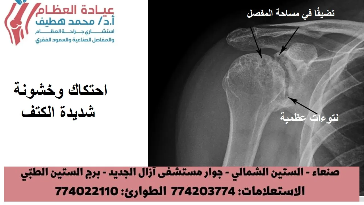 أعراض الم . أكثر أعراض التهاب مفصل الكتف شيوعًا هو الألم. يتفاقم هذا الألم بسبب النشاط ويزداد سوءًا بمرور الوقت. يختلف مكان الألم ، اعتمادًا على مفصل الكتف المصاب: إذا تأثر مفصل الكتف الحقاني العضدي ، يتركز الألم في جانب أو مؤخرة الكتف وقد يتفاقم مع التغيرات في الطقس. يشكو المرضى من وجع عميق في المفصل. يتركز ألم التهاب المفاصل في المفصل الأخرمي الترقوي على الجزء العلوي من الكتف. يمكن أن ينتقل هذا الألم أحيانًا أو ينتقل إلى جانب الرقبة. قد يعاني الشخص المصاب بالتهاب المفاصل الروماتويدي من ألم في جميع أنحاء الكتف إذا تأثر كل من المفصل الحقاني العضدي والمفصل الأخرمي الترقوي (AC).. مع تقدم المرض ، فإن أي حركة للكتف تسبب الألم. الألم الليلي شائع ، وقد يكون النوم صعبًا. في هذه النشرة التهاب مفاصل الكتف احتكاك مفاصل الكتف خشونة مفاصل الكتف- ملخص التهاب مفاصل الكتف احتكاك مفاصل الكتف خشونة مفاصل الكتف- تشريح التهاب مفاصل الكتف احتكاك مفاصل الكتف خشونة مفاصل الكتف- وصف التهاب مفاصل الكتف احتكاك مفاصل الكتف خشونة مفاصل الكتف- أعراض التهاب مفاصل الكتف احتكاك مفاصل الكتف خشونة مفاصل الكتف- فحص الطبيب التهاب مفاصل الكتف احتكاك مفاصل الكتف خشونة مفاصل الكتف- العلاج قد تشمل الأعراض الأخرى: نطاق محدود من الحركة. تعد الحركة المحدودة من الأعراض الشائعة الأخرى. قد يصبح رفع ذراعك أكثر صعوبة لتمشيط شعرك أو الوصول إلى الرف. قد تسمع صوت طحن أو نقر أو فرقعة أثناء تحريك كتفك. أحيانًا يكون صوت الفرقعة مؤلمًا ويمكن أن يكون مرتفعًا بما يكفي ليستمع إليه الآخرون ، مقالات ذات صلة تمارين تأهيل الكفة والكتف أساسيات صحة العظام خلع الكتف اضطرابات المفصل القصي الترقوي تمزق الكفة المدورة التهاب وتر العضلة ذات الرأسين التهاب مفاصل الكتف هشاشة العظام كيف يمكنني العثور على أفضل جراح عظام اليمن صنعاء؟ لصفحة التالية:التهاب مفاصل الكتف احتكاك مفاصل الكتف خشونة مفاصل الكتف- فحص الطبيب انظر كل ما يتعلق بالكتف هن