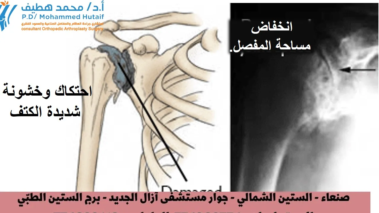 التهاب مفاصل الكتف احتكاك مفاصل الكتف خشونة مفاصل الكتف ملخص   كل عام ، يتم تشخيص ملايين الأشخاص حول العالم بأحد أشكال التهاب المفاصل. يُعرف التهاب المفاصل ببساطة بأنه التهاب في مفصل أو أكثر من مفاصلك. في الكتف المصاب ، يسبب هذا الالتهاب ألمًا وتيبسًا يمكن أن يجعل من الصعب رفع ذراعك أو تمشيط شعرك أو الوصول إلى رف مرتفع. على الرغم من عدم وجود علاج شافٍ لالتهاب مفاصل الكتف ، إلا أن هناك العديد من خيارات العلاج المتاحة. بحيث، يمكن لمعظم الأشخاص المصابين بالتهاب المفاصل التحكم في الألم والبقاء نشيطين.     تشريح   كتفك مكونة من ثلاث عظام:   عظم العَضُد  (الذراع ) عظم اللَّوْح أو لوح الكتف  الترقوة  يتناسب رأس عظمة الجزء العلوي من ذراعك مع تجويف دائري في كتفك. هذا التجويف يسمى الحقاني. مجموعة من العضلات والأوتار تحافظ على مركز عظم ذراعك في تجويف الكتف. تسمى هذه أنسجة الكفة المدورة.   يوجد مفصلان في الكتف وقد يتأثر كلاهما بالتهاب المفاصل. يوجد مفصل حيث تلتقي الترقوة بطرف لوح الكتف (الأخرم). وهذا ما يسمى المفصل الأخرمي الترقوي (AC). والثاني هو مكان وضع رأس عظم العضد في لوح الكتف ويسمى المفصل الحقاني العضدي.      رسم توضيحي لتشريح الكتف الطبيعي   العلاج الفعال، يستلزم تحديد المفصل المصاب ونوع التهاب المفاصل الذي تعاني منه.   وصف خمسة أنواع رئيسية من التهاب المفاصل تؤثر عادة على الكتف.   احتكاك او خشونة العظام يُعرف أيضًا باسم التهاب المفاصل "التآكل والتلف" ، وهو حالة تؤدي إلى تدمير الغطاء الخارجي الأملس (الغضروف المفصلي) للعظام. مع تآكل الغضروف المفصلي ، يصبح مهترئًا وخشنًا ، وتقل المساحة الواقية بين العظام.  أثناء الحركة ، تحتك عظام المفصل ببعضها البعض ، مما يسبب الألم.  غالبًا ما يشار إلى هذا باسم التهاب المفاصل او احتكاك او خشونة العظام "العظم على العظم".   عادةً ما يصيب احتكاك او خشونة العظام الأشخاص الذين تزيد أعمارهم عن 50 عامًا وهو أكثر شيوعًا في المفصل الأخرمي الترقوي منه في مفصل الكتف الحقاني العضدي.        رسم توضيحي وأشعة سينية يظهران احتكاك او خشونة العظام في الكتف وانخفاض مساحة المفصل     التهاب المفاصل الرثوي (الروماتويدي) والتهاب المفاصل الرثوي هو حالة مزمنة تصيب المفاصل على جانبي الجسم، فيصيب مثلًا كلتا اليدين أو المعصمين و/أو الركبتين. وتتميز هذه الحالة عن غيرها من أنواع التهاب المفاصل الأخرى بتعدد وتناسق التهاب المفاصل بهذه الطريقة. تُغطى مفاصل جسمك ببطانة - تسمى الغشاء الزليلي - تعمل على تليين المفصل وتسهيل حركته. يتسبب التهاب المفاصل الروماتويدي في انتفاخ البطانة ، مما يسبب ألمًا وتيبسًا في المفصل. ولا يقتصر التهاب المفاصل الرثوي على المفاصل وحسب، فأحيانًا يمكن أن يصيب أعضاء الجسم الُأخرى كالجلد والعينين والرئتين والقلب والدم والأعصاب والكليتين. التهاب المفاصل الروماتويدي هو أحد أمراض المناعة الذاتية. هذا يعني أن الجهاز المناعي يهاجم أنسجته. في التهاب المفاصل الروماتويدي ، تعمل الدفاعات التي تحمي الجسم من العدوى على إتلاف الأنسجة الطبيعية (مثل الغضاريف والأربطة) وتليين العظام. التهاب المفاصل الروماتويدي شائع أيضًا في كلا مفصلي الكتف. التهاب المفاصل ما بعد الصدمة التهاب المفاصل ما بعد الصدمة هو شكل من أشكال هشاشة العظام الذي يتطور بعد الإصابة ، مثل كسر أو خلع في الكتف.   تمزق الكُفَّة المُدَوِّرَة أو الكُفَّة المديرة يمكن أن يتطور التهاب المفاصل أيضًا بعد تمزق وتر الكفة المدورة. اذ لم يعد بإمكان الكفة المدورة الممزقة تثبيت رأس عظم العضد في التجويف الحقاني، ويمكن لعظم العضد أن يتحرك لأعلى ويحتك مع الأخرم. يمكن أن يؤدي ذلك إلى إتلاف أسطح العظام ، مما يؤدي إلى الإصابة بالتهاب مفاصل الكتف او احتكاك مفاصل الكتف  اوخشونة مفاصل الكتف   يمكن أن يؤدي الجمع بين تمزق الكفة المدورة الكبير والتهاب المفاصل المتقدم إلى ألم شديد وضعف ، وقد لا يتمكن المريض من رفع ذراعه.        رسم توضيحي لاعتلال مفاصل الكفة المدورة     مرض نقصان الدم المزود للعظام (النخر اللاوعائي) النخر اللاوعائي (AVN) للكتف هو حالة مؤلمة تحدث عندما ينقطع تدفق الدم إلى رأس عظم العضد. لأن الخلايا العظمية تموت دون إمداد الدم ، يمكن أن يؤدي مرض نقصان الدم المزود للعظام (النخر اللاوعائي)في النهاية إلى تدمير مفصل الكتف.   يتطور النخر اللاوعائي على مراحل. مع تقدمه ، ينهار العظم الميت تدريجيًا ، مما يؤدي إلى إتلاف الغضروف المفصلي الذي يغطي العظم ويؤدي إلى التهاب المفاصل. في البداية ، يؤثر مرض نقصان الدم المزود للعظام (النخر اللاوعائي)فقط على رأس عظم العضد ، ولكن مع تقدم مرض نقصان الدم المزود للعظام (النخر اللاوعائي)، يمكن أن يتسبب رأس عظم العضد المنهار في إتلاف التجويف الحقاني.   تشمل أسباب مرض نقصان الدم المزود للعظام (النخر اللاوعائي)استخدام جرعات عالية من الستيرويد ، والإفراط في استهلاك الكحول ، ومرض الخلايا المنجلية ، والإصابات الرضحية ، مثل كسور الكتف. في بعض الحالات ، لا يمكن تحديد سبب ؛ يشار إلى هذا باسم مرض نقصان الدم المزود للعظام (النخر اللاوعائي)مجهول السبب.   أعراض الم. أكثر أعراض التهاب مفصل الكتف شيوعًا هو الألم. يتفاقم هذا الألم بسبب النشاط ويزداد سوءًا بمرور الوقت. يختلف مكان الألم ، اعتمادًا على مفصل الكتف المصاب:   إذا تأثر مفصل الكتف الحقاني العضدي ، يتركز الألم في جانب أو مؤخرة الكتف وقد يتفاقم مع التغيرات في الطقس. يشكو المرضى من وجع عميق في المفصل. يتركز ألم التهاب المفاصل في المفصل الأخرمي الترقوي على الجزء العلوي من الكتف. يمكن أن ينتقل هذا الألم أحيانًا أو ينتقل إلى جانب الرقبة. قد يعاني الشخص المصاب بالتهاب المفاصل الروماتويدي من ألم في جميع أنحاء الكتف إذا تأثر كل من المفصل الحقاني العضدي والمفصل الأخرمي الترقوي (AC).. مع تقدم المرض ، فإن أي حركة للكتف تسبب الألم. الألم الليلي شائع ، وقد يكون النوم صعبًا.   قد تشمل الأعراض الأخرى:   نطاق محدود من الحركة. تعد الحركة المحدودة من الأعراض الشائعة الأخرى. قد يصبح رفع ذراعك أكثر صعوبة لتمشيط شعرك أو الوصول إلى الرف.    قد تسمع صوت طحن أو نقر أو فرقعة أثناء تحريك كتفك. أحيانًا يكون صوت الفرقعة مؤلمًا ويمكن أن يكون مرتفعًا بما يكفي ليستمع إليه الآخرون ،   فحص الطبيب التاريخ الطبي والفحص البدني بعد مناقشة الأعراض والتاريخ الطبي ، سيفحص طبيبك كتفك.   أثناء الفحص البدني ، سيبحث طبيبك عن:   ضعف (ضمور) العضلات الم عند للمس مدى نطاق الحركة السلبي (المساعد) والنشط (الموجه ذاتيا) ألم عند الضغط على المفصل أي علامات إصابة في العضلات والأوتار والأربطة المحيطة بالمفصل علامات الإصابات أو العمليات الجراحية السابقة إصابة المفاصل الأخرى (دلالة على التهاب المفاصل الروماتويدي)   الأشعة السينية الأشعة السينية هي اختبارات تصوير تخلق صورًا مفصلة للهياكل الكثيفة ، مثل العظام. يمكنهم المساعدة في التمييز بين الأشكال المختلفة لالتهاب المفاصل.   ستظهر الأشعة السينية للكتف المصابة بالتهاب المفاصل تضيقًا في مساحة المفصل ، وتغيرات في العظام ، وتشكيل نتوءات عظمية (نبتات عظمية)       .   تُظهر هذه الأشعة السينية الإصابة بالتهاب الكتف او احتكاك الكتف اوخشونة  الكتف شديدة في المفصل الحقاني العضدي.        العلاج  العلاج غير الجراحي كما هو الحال مع حالات التهاب المفاصل الأخرى ، فإن العلاج الأولي لالتهاب مفاصل الكتف غير جراحي. قد يوصي طبيبك بما يلي:   الراحة أو التغيير في الأنشطة. قد تحتاج إلى تغيير طريقة تحريك ذراعك لتجنب إثارة الألم. قد تحسن تمارين العلاج الطبيعي نطاق الحركة في كتفك. قد تقلل العقاقير غير الستيرويدية المضادة للالتهابات (NSAIDs) ، مثل الأسبرين أو الأيبوبروفين أو النابروكسين ، الالتهاب والألم. يمكن أن تهيج هذه الأدوية بطانة المعدة وتسبب نزيفًا داخليًا. يجب تناولها مع الطعام.  استشر طبيبك قبل تناول مضادات الالتهاب غير الستيرويدية التي لا تستلزم وصفة طبية  يمكن لحقن الكورتيكوستيرويد في الكتف أن يقلل بشكل كبير من الالتهاب والألم. ومع ذلك ، فإن التأثير غالبًا ما يكون مؤقتًا.   قد توفر الحرارة الرطبة راحة مؤقتة. ضع الثلج على كتفك لمدة 20 إلى 30 دقيقة مرتين أو ثلاث مرات في اليوم لتقليل الالتهاب وتخفيف الألم. إذا كنت مصابًا بالتهاب المفاصل الروماتويدي ، فقد يصف لك طبيبك (اختصاصي أمراض الروماتيزم عادةً) دواءً معدلاً للمرض ، مثل الميثوتريكسات.   قد تساعد المكملات الغذائية ، مثل الجلوكوزامين وكبريتات شوندروتن في تخفيف الألم. (ملاحظة: هناك القليل من الأدلة العلمية لدعم استخدام الجلوكوزامين وكبريتات شوندروتن لعلاج التهاب المفاصل. بالإضافة إلى ذلك ، لا تختبر إدارة الغذاء والدواء الأمريكية المكملات الغذائية. قد تسبب هذه المركبات تفاعلات سلبية مع الأدوية الأخرى. استشر طبيبك دائمًا قبل تناول المكملات الغذائية.) العلاج الجراحي قد يفكر طبيبك في الجراحة إذا كان ألمك يسبب إعاقة ولم يتم تخفيفه بالعلاج غير الجراحي.   تنظير المفصل. يمكن علاج حالات التهاب المفاصل الحقاني العضدي الخفيف عن طريق تنظير المفصل ، أثناء تنظير المفاصل ، يقوم الطبيب بإدخال كاميرا صغيرة تسمى منظار المفصل في مفصل الكتف. تعرض الكاميرا الصور على شاشة فيديو ، ويستخدم الطبيب هذه الصور لتوجيه الأدوات الجراحية المصغرة.   نظرًا لأن منظار المفصل والأدوات الجراحية رفيعة ، يمكن للجراح استخدام شقوق صغيرة جدًا بدلاً من الشق الأكبر المطلوب لإجراء الجراحة القياسية المفتوحة.   أثناء الإجراء ، يمكن لطبيبك أن ينظف  الجزء الداخلي من المفصل. على الرغم من أن الإجراء يخفف الآلام ، إلا أنه لن يقضي على التهاب المفاصل من المفصل. إذا تطور التهاب المفاصل ، فقد تكون هناك حاجة إلى مزيد من الجراحة في المستقبل.   استبدال مفصل الكتف (تقويم المفاصل). يمكن علاج التهاب المفاصل المتقدم في المفصل الحقاني العضدي بجراحة استبدال الكتف. في هذا الإجراء ، تتم إزالة الأجزاء التالفة من الكتف واستبدالها بمكونات صناعية تسمى الأطراف الاصطناعية.   تشمل خيارات جراحة الاستبدال ما يلي:   استبدال المفصل النصفي. يتم استبدال رأس عظم العضد بمكون اصطناعي. تقويم مفصل الكتف الكلي . يتم استبدال كل من رأس عظم العضد والحقاني. يتم تركيب كوب بلاستيكي في الحقاني ، ويتم توصيل كرة معدنية بأعلى عظم العضد. عكس تقويم مفصل الكتف الكلي . في الاستبدال الكلي للكتف ، يكون التجويف والكرة المعدنية في مواجهة تقويم مفصل الكتف الكلي التقليدي. يتم تثبيت الكرة المعدنية على الحقاني ، ويتم تثبيت الكوب البلاستيكي في الطرف العلوي من عظم العضد. يعمل الاستبدال الكلي العكسي للكتف بشكل أفضل للأشخاص الذين يعانون من اعتلال مفصل الكفة لأنه يعتمد على عضلات مختلفة - وليس الكفة المدورة - لتحريك الذراع.            خيارات جراحة الاستبدال    رأب المفصل الاستئصالي. الإجراء الجراحي الأكثر شيوعًا المستخدم لعلاج التهاب المفاصل في المفصل الأخرمي الترقوي هو رأب المفاصل الاستئصالي. اعتمادًا على حالتك الخاصة ، يمكن إجراء هذا الإجراء إما بالمنظار أو من خلال الجراحة المفتوحة التقليدية.    