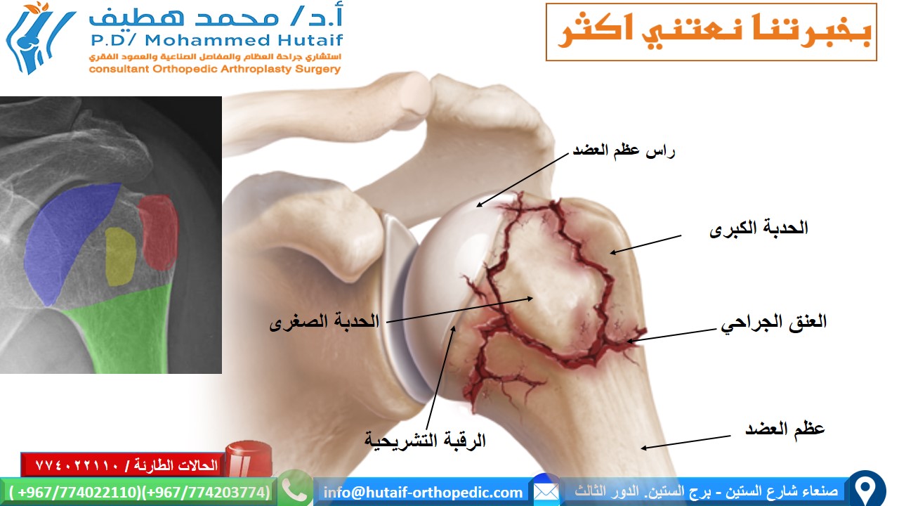 كسور راس عظم العضد القريبة الملخص كسور العضد القريبة هي إصابات شائعة للغاية ، وهي واحدة من كسور هشاشة العظام الحقيقية. يمكن معالجة معظم الكسور بشكل فعال  من غير جراحة ، حيث أن الأوعية الدموية الغنية والأسطح العريضة تمنح ميلًا كبيرًا للشفاء. بالإضافة إلى ذلك ، تؤدي العديد من أنماط الكسور إلى ملامسة عظام كافية وإزاحة أقل مع محاذاة مقبولة. يمكن أن يؤدي الرد المفتوح والتثبيت الداخلي للكسور النازحة إلى تحسين النتائج ، اعتمادًا على الحالة الوظيفية للمريض قبل الإصابة. إذا تم اختيار العلاج الجراحي ، فيجب التغلب على تحديات العلاج الفريدة ، بما في ذلك تشخيص شظايا العظام الصغيرة والحفاظ عليها مع قوى عضلية قوية ، غالبًا في العظام التي تعاني من هشاشة العظام. العديد من الخيارات مجدية ، بما في ذلك الألواح والمسامير والخيوط وغيرها من الأجهزة الجديدة.  الموقع التشريحي قد تحدث كسور راس عظم العضد في العنق الجراحي ، والرقبة التشريحية ، والحدبة الكبرى ، والحدبة الصغرى تعتبر كسور الرقبة الجراحية من جزأين أكثر شيوعًا عوامل الخطر هشاشة العظام داء السكري الصرع الإناث الإصابات المصاحبة إصابة العصب إصابة العصب الإبطي الأكثر شيوعًا إصابة الشرايين غير شائع (حدوث 5-6٪) ، احتمالية أعلى عند المرضى الأكبر سنًا غالبًا ما يحدث على مستوى الرقبة الجراحية أو مع خلع تحت الغشاء العظمي للرأس  كيف نصنف كسور العضد القريبة؟ على أساس العلاقة التشريحية المكونة من 4 أجزاء   كسور جزء واحد  كسور من جزئين  كسور من ثلاثة أجزاء  كسور من أربعة أجزاء . .  خلع وكسور إصابات سطح المفصل تمت إضافة فئات منفصلة للاضطرابات لأنها تمثل إصابات أكثر خطورة، وأكثر عرضة للإصابة بالنخر اللاوعائي وتطور التعظم غير المتجانس. وبالمثل ، تم وضع كسور السطح المفصلي في فئة منفصلة بسبب اعتبارات علاجها الفريدة. تأتي هذه في نوعين، كسور شظية للرأس وكسور انحشار.  خيارات العلاج لكسور راس عظم العضد القريبة  إذا كان كسر عظم العضد القريب غير مزاح ومستقر ، فقد تكون الإدارة غير الجراحية خيارًا قابلاً للتطبيق. قد يتألف هذا من ارتداء حامل ذراع ، والراحة ، وأدوية للألم ، وعلاج طبيعي لطيف بعد التئام الكسر. عادة ما يستغرق العظم من 8 إلى 12 أسبوعًا حتى تتكون كتلة الالتحام الأساسية. يعد الحفاظ على الذراع مدعومًا والحد من مقدار الضغط على الكسر أمرًا أساسيًا. الخيارات الجراحية  تعتمد علي عدة عوامل منها  هل الكسور مفتوحة ماهو التصنيف الدقيق للكسر؟ عمر المريض الإصابات المصاحبة  