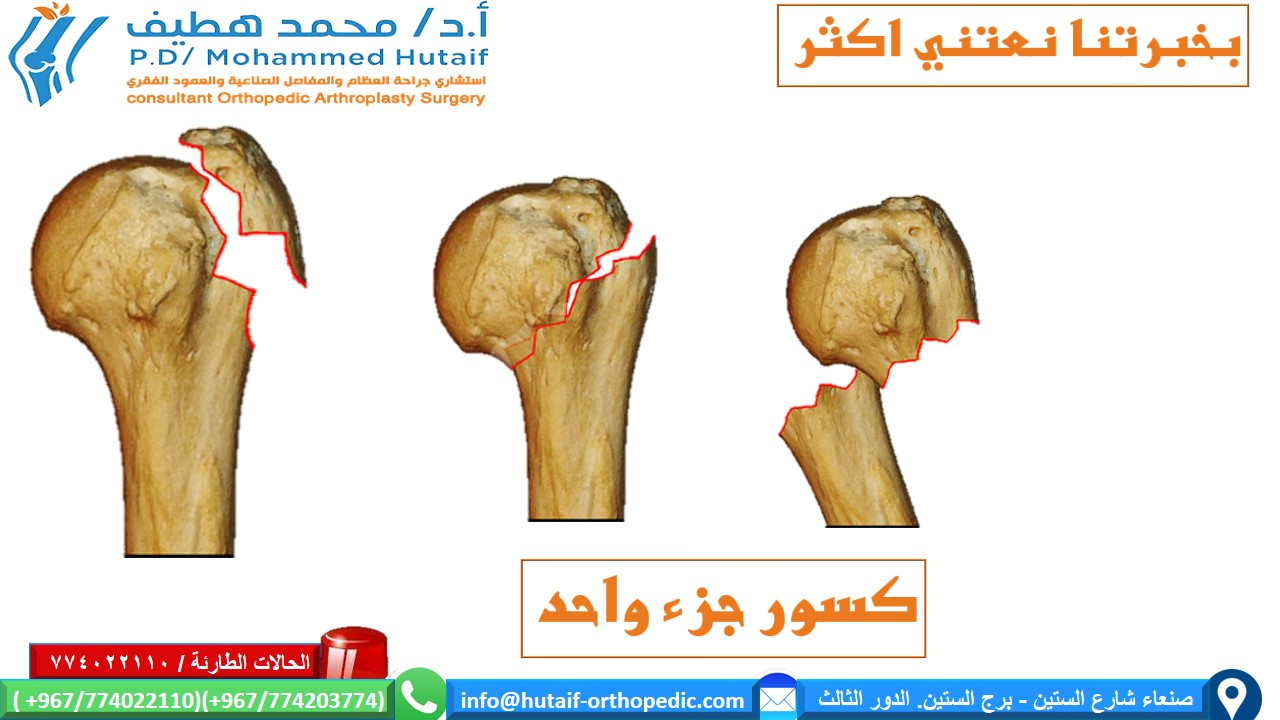كسور راس عظم العضد القريبة الملخص كسور العضد القريبة هي إصابات شائعة للغاية ، وهي واحدة من كسور هشاشة العظام الحقيقية. يمكن معالجة معظم الكسور بشكل فعال  من غير جراحة ، حيث أن الأوعية الدموية الغنية والأسطح العريضة تمنح ميلًا كبيرًا للشفاء. بالإضافة إلى ذلك ، تؤدي العديد من أنماط الكسور إلى ملامسة عظام كافية وإزاحة أقل مع محاذاة مقبولة. يمكن أن يؤدي الرد المفتوح والتثبيت الداخلي للكسور النازحة إلى تحسين النتائج ، اعتمادًا على الحالة الوظيفية للمريض قبل الإصابة. إذا تم اختيار العلاج الجراحي ، فيجب التغلب على تحديات العلاج الفريدة ، بما في ذلك تشخيص شظايا العظام الصغيرة والحفاظ عليها مع قوى عضلية قوية ، غالبًا في العظام التي تعاني من هشاشة العظام. العديد من الخيارات مجدية ، بما في ذلك الألواح والمسامير والخيوط وغيرها من الأجهزة الجديدة.  الموقع التشريحي قد تحدث كسور راس عظم العضد في العنق الجراحي ، والرقبة التشريحية ، والحدبة الكبرى ، والحدبة الصغرى تعتبر كسور الرقبة الجراحية من جزأين أكثر شيوعًا عوامل الخطر هشاشة العظام داء السكري الصرع الإناث الإصابات المصاحبة إصابة العصب إصابة العصب الإبطي الأكثر شيوعًا إصابة الشرايين غير شائع (حدوث 5-6٪) ، احتمالية أعلى عند المرضى الأكبر سنًا غالبًا ما يحدث على مستوى الرقبة الجراحية أو مع خلع تحت الغشاء العظمي للرأس  كيف نصنف كسور العضد القريبة؟ على أساس العلاقة التشريحية المكونة من 4 أجزاء   كسور جزء واحد  كسور من جزئين  كسور من ثلاثة أجزاء  كسور من أربعة أجزاء . .  خلع وكسور إصابات سطح المفصل تمت إضافة فئات منفصلة للاضطرابات لأنها تمثل إصابات أكثر خطورة، وأكثر عرضة للإصابة بالنخر اللاوعائي وتطور التعظم غير المتجانس. وبالمثل ، تم وضع كسور السطح المفصلي في فئة منفصلة بسبب اعتبارات علاجها الفريدة. تأتي هذه في نوعين، كسور شظية للرأس وكسور انحشار.  خيارات العلاج لكسور راس عظم العضد القريبة  إذا كان كسر عظم العضد القريب غير مزاح ومستقر ، فقد تكون الإدارة غير الجراحية خيارًا قابلاً للتطبيق. قد يتألف هذا من ارتداء حامل ذراع ، والراحة ، وأدوية للألم ، وعلاج طبيعي لطيف بعد التئام الكسر. عادة ما يستغرق العظم من 8 إلى 12 أسبوعًا حتى تتكون كتلة الالتحام الأساسية. يعد الحفاظ على الذراع مدعومًا والحد من مقدار الضغط على الكسر أمرًا أساسيًا. الخيارات الجراحية  تعتمد علي عدة عوامل منها  هل الكسور مفتوحة ماهو التصنيف الدقيق للكسر؟ عمر المريض الإصابات المصاحبة  