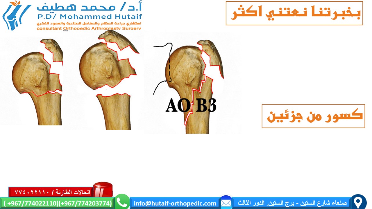 كسور راس عظم العضد القريبة الملخص كسور العضد القريبة هي إصابات شائعة للغاية ، وهي واحدة من كسور هشاشة العظام الحقيقية. يمكن معالجة معظم الكسور بشكل فعال  من غير جراحة ، حيث أن الأوعية الدموية الغنية والأسطح العريضة تمنح ميلًا كبيرًا للشفاء. بالإضافة إلى ذلك ، تؤدي العديد من أنماط الكسور إلى ملامسة عظام كافية وإزاحة أقل مع محاذاة مقبولة. يمكن أن يؤدي الرد المفتوح والتثبيت الداخلي للكسور النازحة إلى تحسين النتائج ، اعتمادًا على الحالة الوظيفية للمريض قبل الإصابة. إذا تم اختيار العلاج الجراحي ، فيجب التغلب على تحديات العلاج الفريدة ، بما في ذلك تشخيص شظايا العظام الصغيرة والحفاظ عليها مع قوى عضلية قوية ، غالبًا في العظام التي تعاني من هشاشة العظام. العديد من الخيارات مجدية ، بما في ذلك الألواح والمسامير والخيوط وغيرها من الأجهزة الجديدة.  الموقع التشريحي قد تحدث كسور راس عظم العضد في العنق الجراحي ، والرقبة التشريحية ، والحدبة الكبرى ، والحدبة الصغرى تعتبر كسور الرقبة الجراحية من جزأين أكثر شيوعًا عوامل الخطر هشاشة العظام داء السكري الصرع الإناث الإصابات المصاحبة إصابة العصب إصابة العصب الإبطي الأكثر شيوعًا إصابة الشرايين غير شائع (حدوث 5-6٪) ، احتمالية أعلى عند المرضى الأكبر سنًا غالبًا ما يحدث على مستوى الرقبة الجراحية أو مع خلع تحت الغشاء العظمي للرأس  كيف نصنف كسور العضد القريبة؟ على أساس العلاقة التشريحية المكونة من 4 أجزاء   كسور جزء واحد  كسور من جزئين  كسور من ثلاثة أجزاء  كسور من أربعة أجزاء . .  خلع وكسور إصابات سطح المفصل تمت إضافة فئات منفصلة للاضطرابات لأنها تمثل إصابات أكثر خطورة، وأكثر عرضة للإصابة بالنخر اللاوعائي وتطور التعظم غير المتجانس. وبالمثل ، تم وضع كسور السطح المفصلي في فئة منفصلة بسبب اعتبارات علاجها الفريدة. تأتي هذه في نوعين، كسور شظية للرأس وكسور انحشار.  خيارات العلاج لكسور راس عظم العضد القريبة  إذا كان كسر عظم العضد القريب غير مزاح ومستقر ، فقد تكون الإدارة غير الجراحية خيارًا قابلاً للتطبيق. قد يتألف هذا من ارتداء حامل ذراع ، والراحة ، وأدوية للألم ، وعلاج طبيعي لطيف بعد التئام الكسر. عادة ما يستغرق العظم من 8 إلى 12 أسبوعًا حتى تتكون كتلة الالتحام الأساسية. يعد الحفاظ على الذراع مدعومًا والحد من مقدار الضغط على الكسر أمرًا أساسيًا. الخيارات الجراحية  تعتمد علي عدة عوامل منها  هل الكسور مفتوحة ماهو التصنيف الدقيق للكسر؟ عمر المريض الإصابات المصاحبة  