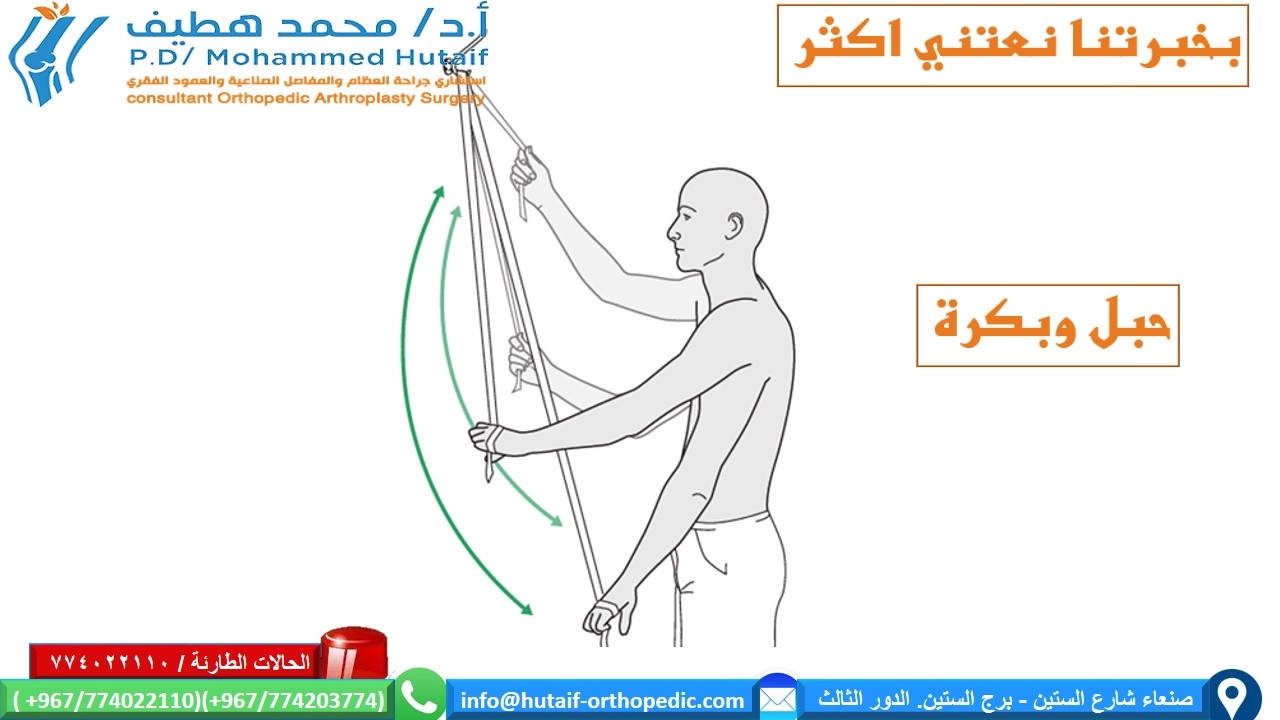 العلاج غير الجراحي كسور راس عظم العضد القريبة يجب أن يوفر العلاج غير الجراحي دعمًا ميكانيكيًا لفترة حتى يشعر المريض بالراحة الكافية لبدء استخدام الكتف ، ويتم دمج الكسر بشكل كافٍ بحيث يكون الازاحة غير محتملة. بمجرد تحقيق هذه الأهداف ، يمكن أن تبدأ التدريبات التأهيلية في استعادة نطاق الحركة ، متبوعًا بالقوة والوظيفة. وهكذا تكون المراحل الثلاث للعلاج غير الجراحي 1) التثبيت 2) نطاق الحركة الخاملة / المساعدة 3) تمارين المقاومة التقدمية يجب أن تكون مدة التثبيت قصيرة قدر الإمكان وطويلة فترة الضرورة. عادة ، يوصى بالتثبيت لمدة 2-3 أسابيع ، متبوعًا بمجموعة لطيفة من تمارين الحركة. يمكن أن تبدأ تمارين المقاومة بشكل عام في الأسبوع السادس. قد تساعد تمارين متساوية القياس في الحفاظ على القوة خلال الأسابيع الستة الأولى. يتم تحقيق الاستقرار الأمثل للكتف عندما يتم تثبيت الجزء العلوي من الذراع والساعد في الصدر. تقليديا ، تم القيام بذلك باستخدام حبال تدعم الكوع والساعد وتتصدى لوزن الذراع. أبسط حبال هو ضمادة مثلثة مربوطة خلف الرقبة. يتم توفير دعم إضافي من خلال رقعة تلتف حول عظم العضد والصدر لتقييد حركة الكتف بشكل أكبر ، والحفاظ على الذراع بإحكام في الحمالة. توفر الأجهزة المتاحة تجاريًا تثبيتًا مشابهًا ، مع أو بدون دعم محيطي من قطعة قماش. توفر جميع هذه الأجهزة دعمًا مشابهًا بشكل أساسي لمفصل الكتف. أبسط دعامة للذراع هي ما يسمى بالياقة والكفة(طوق وكفة) التي تحد من حركة الكتف لكنها لا تدعم الكثير من وزن الذراع. قد يكون هذا مرغوبًا عندما يُتوقع أن يؤدي الجر اللطيف إلى تحسين محاذاة الكسر. توفر ثباتًا أقل من الرافعة ، مع أو بدون مسند ، ويجب إزالتها لحركة الكتف أو الكوع. يمكن ارتداء معظم دعامات الكتف أسفل ملابس المريض أو خارجها. يساعد إبقاء اليد في متناول اليد وتشجيع المريض على التحرك باستخدام الرسغ والأصابع ، على منع التصلب الذي قد يكون من الصعب جدًا تصحيحه إذا سمح له بالتطور يمكن علاج الإزاحة الطفيفة إلى المعتدلة لكسور العضد القريبة عن طريق الدعم الخارجي وحده. تعتبر علاقة الذراع العريضة هي الطريقة الأكثر شيوعا. في أبسط أشكالها ، يتم لف ضمادة مثلثة حول الكوع والساعد وربطها خلف الرقبة. يمكن ضبط الدعامات لتجنب الإزاحةفي الكتف الذي قد يسبب انحرافا غير مرغوب فيه. تتوفر الرافعات التجارية لتوفير دعم مماثل. لتخفيف التوتر على وتر فوق الشوكة و الحدبة الكبري ، يمكن للمرء أن يدعم الذراع في سادة تبعيد الكتف الي الخارج . يمكن القيام بذلك باستخدام ما يسمى جبيرة الطائرة أو وسادة تبعيد الكتف كما هو موضح. - الحركة: 2-3 أسابيع بعد الصدمة