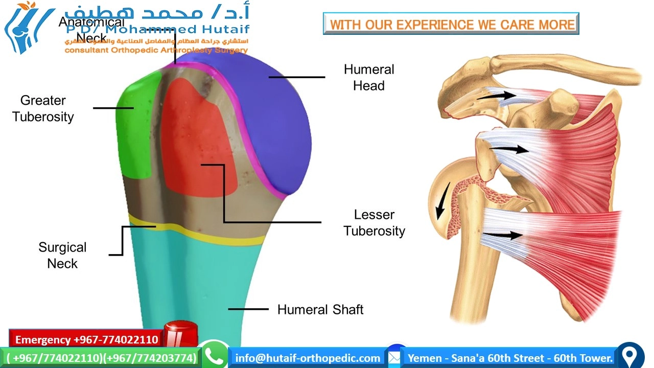 Proximal humerus fractures  Summary Proximal humerus fractures are very common injuries, and they are one of the true osteoporotic fractures. Most fractures can be treated effectively without surgery, as the rich blood vessels and wide surfaces give a great tendency to heal. In addition, many fracture patterns result in adequate bone contact and less displacement with acceptable alignment. Open reduction and internal fixation of displaced fractures can improve outcomes, depending on the functional status of the patient prior to injury. If surgical treatment is chosen, unique treatment challenges must be overcome, including the diagnosis and preservation of small bone fragments with strong muscular forces, often in bones with osteoporosis. Many options are feasible, including plates, screw, wires, and other hardware.   anatomical location Fractures of the head of the humerus may occur in the surgical neck, the anatomical neck, the greater tuberosity, and the lesser tuberosity  Two-part surgical neck fractures are most common  risk factors Osteoporosis diabetic epilepsy female Associated injuries nerve injury Most common axillary nerve injury  Arterial injury Uncommon (incidence 5-6%), higher probability in older patients  It often occurs at the surgical neck level or with subluxation of the head     How do we classify proximal humeral fractures? On the basis of the anatomical relationship consisting of 4 parts      How do we classify proximal humeral fractures? On the basis of the anatomical relationship consisting of 4 parts        single part  fractures   two-part fractures   Three-part fractions   Four-part fractions   Dislocations and fractures of joint surface injuries Separate categories have been added because they represent more severe injuries, are more likely to develop avascular necrosis . Likewise, fractures of the articular surface have been placed in a separate category due to their unique treatment considerations.     Treatment options for proximal humeral head fractures  Non-surgical management If the proximal humerus fracture is non-displaced and stable, nonsurgical management may be a viable option. This may consist of wearing an arm sling, rest, pain medication, and gentle physical therapy after the fracture has healed. The bone usually takes 8 to 12 weeks for the primary fusion mass to form. Keeping the arm supported and reducing the amount of stress on the fracture is key.  Surgical options It depends on several factors, including:  Are fractures open? What is the exact classification of fracture? patient's age Associated injuries