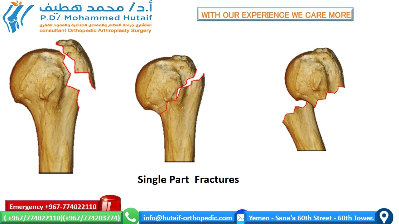 Proximal humerus fractures  Summary Proximal humerus fractures are very common injuries, and they are one of the true osteoporotic fractures. Most fractures can be treated effectively without surgery, as the rich blood vessels and wide surfaces give a great tendency to heal. In addition, many fracture patterns result in adequate bone contact and less displacement with acceptable alignment. Open reduction and internal fixation of displaced fractures can improve outcomes, depending on the functional status of the patient prior to injury. If surgical treatment is chosen, unique treatment challenges must be overcome, including the diagnosis and preservation of small bone fragments with strong muscular forces, often in bones with osteoporosis. Many options are feasible, including plates, screw, wires, and other hardware.   Anatomical location Fractures of the head of the humerus may occur in the surgical neck, the anatomical neck, the greater tuberosity, and the lesser tuberosity  Two-part surgical neck fractures are most common  Risk factors Osteoporosis Diabetic Epilepsy Female Associated injuries Nerve injury Most common axillary nerve injury  Arterial injury Uncommon (incidence 5-6%), higher probability in older patients  It often occurs at the surgical neck level or with subluxation of the head     How do we classify proximal humeral fractures? On the basis of the anatomical relationship consisting of 4 parts      How do we classify proximal humeral fractures? On the basis of the anatomical relationship consisting of 4 parts  Single part  fractures Two-part fractures  Three-part fractions  Four-part fractions  Dislocations and fractures of joint surface injuries Separate categories have been added because they represent more severe injuries, are more likely to develop avascular necrosis . Likewise, fractures of the articular surface have been placed in a separate category due to their unique treatment considerations.   Treatment options for proximal humeral head fractures  Non-surgical management If the proximal humerus fracture is non-displaced and stable, nonsurgical management may be a viable option. This may consist of wearing an arm sling, rest, pain medication, and gentle physical therapy after the fracture has healed. The bone usually takes 8 to 12 weeks for the primary fusion mass to form. Keeping the arm supported and reducing the amount of stress on the fracture is key.  Surgical options It depends on several factors, including:  Are fractures open? What is the exact classification of fracture? Patient's age Associated injuries