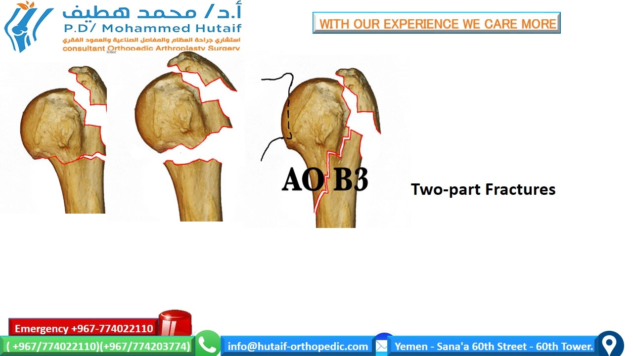 Proximal humerus fractures  Summary Proximal humerus fractures are very common injuries, and they are one of the true osteoporotic fractures. Most fractures can be treated effectively without surgery, as the rich blood vessels and wide surfaces give a great tendency to heal. In addition, many fracture patterns result in adequate bone contact and less displacement with acceptable alignment. Open reduction and internal fixation of displaced fractures can improve outcomes, depending on the functional status of the patient prior to injury. If surgical treatment is chosen, unique treatment challenges must be overcome, including the diagnosis and preservation of small bone fragments with strong muscular forces, often in bones with osteoporosis. Many options are feasible, including plates, screw, wires, and other hardware.   Anatomical location Fractures of the head of the humerus may occur in the surgical neck, the anatomical neck, the greater tuberosity, and the lesser tuberosity  Two-part surgical neck fractures are most common  Risk factors Osteoporosis Diabetic Epilepsy Female Associated injuries Nerve injury Most common axillary nerve injury  Arterial injury Uncommon (incidence 5-6%), higher probability in older patients  It often occurs at the surgical neck level or with subluxation of the head     How do we classify proximal humeral fractures? On the basis of the anatomical relationship consisting of 4 parts      How do we classify proximal humeral fractures? On the basis of the anatomical relationship consisting of 4 parts  Single part  fractures Two-part fractures  Three-part fractions  Four-part fractions  Dislocations and fractures of joint surface injuries Separate categories have been added because they represent more severe injuries, are more likely to develop avascular necrosis . Likewise, fractures of the articular surface have been placed in a separate category due to their unique treatment considerations.   Treatment options for proximal humeral head fractures  Non-surgical management If the proximal humerus fracture is non-displaced and stable, nonsurgical management may be a viable option. This may consist of wearing an arm sling, rest, pain medication, and gentle physical therapy after the fracture has healed. The bone usually takes 8 to 12 weeks for the primary fusion mass to form. Keeping the arm supported and reducing the amount of stress on the fracture is key.  Surgical options It depends on several factors, including:  Are fractures open? What is the exact classification of fracture? Patient's age Associated injuries