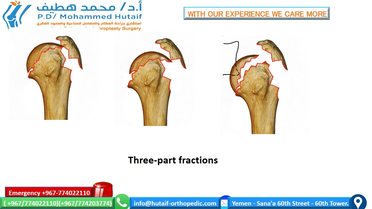 Proximal humerus fractures  Summary Proximal humerus fractures are very common injuries, and they are one of the true osteoporotic fractures. Most fractures can be treated effectively without surgery, as the rich blood vessels and wide surfaces give a great tendency to heal. In addition, many fracture patterns result in adequate bone contact and less displacement with acceptable alignment. Open reduction and internal fixation of displaced fractures can improve outcomes, depending on the functional status of the patient prior to injury. If surgical treatment is chosen, unique treatment challenges must be overcome, including the diagnosis and preservation of small bone fragments with strong muscular forces, often in bones with osteoporosis. Many options are feasible, including plates, screw, wires, and other hardware.   anatomical location Fractures of the head of the humerus may occur in the surgical neck, the anatomical neck, the greater tuberosity, and the lesser tuberosity  Two-part surgical neck fractures are most common  risk factors Osteoporosis diabetic epilepsy female Associated injuries nerve injury Most common axillary nerve injury  Arterial injury Uncommon (incidence 5-6%), higher probability in older patients  It often occurs at the surgical neck level or with subluxation of the head     How do we classify proximal humeral fractures? On the basis of the anatomical relationship consisting of 4 parts      How do we classify proximal humeral fractures? On the basis of the anatomical relationship consisting of 4 parts        single part  fractures   two-part fractures   Three-part fractions   Four-part fractions   Dislocations and fractures of joint surface injuries Separate categories have been added because they represent more severe injuries, are more likely to develop avascular necrosis . Likewise, fractures of the articular surface have been placed in a separate category due to their unique treatment considerations.     Treatment options for proximal humeral head fractures  Non-surgical management If the proximal humerus fracture is non-displaced and stable, nonsurgical management may be a viable option. This may consist of wearing an arm sling, rest, pain medication, and gentle physical therapy after the fracture has healed. The bone usually takes 8 to 12 weeks for the primary fusion mass to form. Keeping the arm supported and reducing the amount of stress on the fracture is key.  Surgical options It depends on several factors, including:  Are fractures open? What is the exact classification of fracture? patient's age Associated injuries