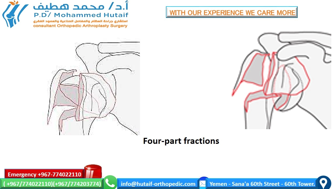 Proximal humerus fractures  Summary Proximal humerus fractures are very common injuries, and they are one of the true osteoporotic fractures. Most fractures can be treated effectively without surgery, as the rich blood vessels and wide surfaces give a great tendency to heal. In addition, many fracture patterns result in adequate bone contact and less displacement with acceptable alignment. Open reduction and internal fixation of displaced fractures can improve outcomes, depending on the functional status of the patient prior to injury. If surgical treatment is chosen, unique treatment challenges must be overcome, including the diagnosis and preservation of small bone fragments with strong muscular forces, often in bones with osteoporosis. Many options are feasible, including plates, screw, wires, and other hardware.   anatomical location Fractures of the head of the humerus may occur in the surgical neck, the anatomical neck, the greater tuberosity, and the lesser tuberosity  Two-part surgical neck fractures are most common  risk factors Osteoporosis diabetic epilepsy female Associated injuries nerve injury Most common axillary nerve injury  Arterial injury Uncommon (incidence 5-6%), higher probability in older patients  It often occurs at the surgical neck level or with subluxation of the head     How do we classify proximal humeral fractures? On the basis of the anatomical relationship consisting of 4 parts      How do we classify proximal humeral fractures? On the basis of the anatomical relationship consisting of 4 parts        single part  fractures   two-part fractures   Three-part fractions   Four-part fractions   Dislocations and fractures of joint surface injuries Separate categories have been added because they represent more severe injuries, are more likely to develop avascular necrosis . Likewise, fractures of the articular surface have been placed in a separate category due to their unique treatment considerations.     Treatment options for proximal humeral head fractures  Non-surgical management If the proximal humerus fracture is non-displaced and stable, nonsurgical management may be a viable option. This may consist of wearing an arm sling, rest, pain medication, and gentle physical therapy after the fracture has healed. The bone usually takes 8 to 12 weeks for the primary fusion mass to form. Keeping the arm supported and reducing the amount of stress on the fracture is key.  Surgical options It depends on several factors, including:  Are fractures open? What is the exact classification of fracture? patient's age Associated injuries