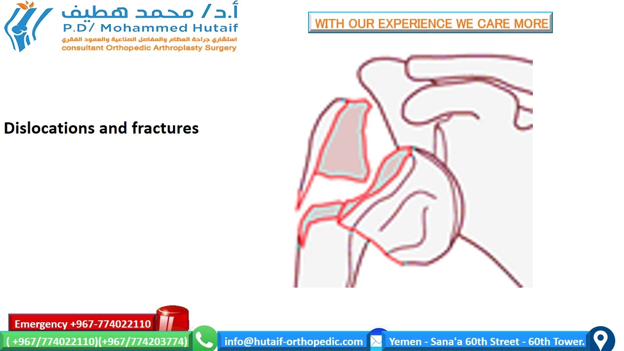 Proximal humerus fractures  Summary Proximal humerus fractures are very common injuries, and they are one of the true osteoporotic fractures. Most fractures can be treated effectively without surgery, as the rich blood vessels and wide surfaces give a great tendency to heal. In addition, many fracture patterns result in adequate bone contact and less displacement with acceptable alignment. Open reduction and internal fixation of displaced fractures can improve outcomes, depending on the functional status of the patient prior to injury. If surgical treatment is chosen, unique treatment challenges must be overcome, including the diagnosis and preservation of small bone fragments with strong muscular forces, often in bones with osteoporosis. Many options are feasible, including plates, screw, wires, and other hardware.   Anatomical location Fractures of the head of the humerus may occur in the surgical neck, the anatomical neck, the greater tuberosity, and the lesser tuberosity  Two-part surgical neck fractures are most common  Risk factors Osteoporosis Diabetic Epilepsy Female Associated injuries Nerve injury Most common axillary nerve injury  Arterial injury Uncommon (incidence 5-6%), higher probability in older patients  It often occurs at the surgical neck level or with subluxation of the head     How do we classify proximal humeral fractures? On the basis of the anatomical relationship consisting of 4 parts      How do we classify proximal humeral fractures? On the basis of the anatomical relationship consisting of 4 parts  Single part  fractures Two-part fractures  Three-part fractions  Four-part fractions  Dislocations and fractures of joint surface injuries Separate categories have been added because they represent more severe injuries, are more likely to develop avascular necrosis . Likewise, fractures of the articular surface have been placed in a separate category due to their unique treatment considerations.   Treatment options for proximal humeral head fractures  Non-surgical management If the proximal humerus fracture is non-displaced and stable, nonsurgical management may be a viable option. This may consist of wearing an arm sling, rest, pain medication, and gentle physical therapy after the fracture has healed. The bone usually takes 8 to 12 weeks for the primary fusion mass to form. Keeping the arm supported and reducing the amount of stress on the fracture is key.  Surgical options It depends on several factors, including:  Are fractures open? What is the exact classification of fracture? Patient's age Associated injuries