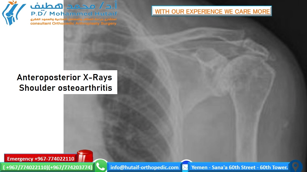Osteoarthritis of the shoulder is a gradual wearing of the articular cartilage that leads to pain and stiffness. As the joint surface degenerates, the subchondral bone remodels, losing its sphericity and congruity. The joint capsule also becomes thickened, leading to further loss of shoulder rotation. This painful condition is a growing problem in the aging population. In most cases, diagnosis of degenerative joint disease of the shoulder can be made with careful history, physical examination, and radiography. The symptoms and degree of shoulder arthritis visible on radiography determine the best treatment option. Mild degenerative joint disease can be treated with physical therapy and over-the-counter anti-inflammatory medications such as acetaminophen or nonsteroidal anti-inflammatory drugs. More advanced cases of osteoarthritis that are refractory to nonoperative management can be managed with corticosteroid injections. In severe cases, surgery is indicated. Surgical options include arthroscopic debridement, arthroscopic capsular release, and, in the most severe instances, hemiarthroplasty or total shoulder arthroplasty.  Shoulder osteoarthritis, also known as degenerative joint disease of the shoulder, is a gradual, progressive, mechanical, and biochemical breakdown of the articular cartilage and other joint tissues, including bone and joint capsule. As the articular surface wears, friction within the joint increases, causing progressive loss of the normal load-bearing surfaces with pain and disability. There are many risk factors for shoulder osteoarthritis, including age, genetics, sex, weight, joint infection, history of shoulder dislocation, and previous injury. Certain occupations, such as heavy construction or overhead sports, are also risk factors. The prevalence of shoulder osteoarthritis is increasing as the population ages. Primary care physicians will be confronted with this disease at various levels of severity. This review highlights epidemiology, evaluation, current treatment options, and treatment results for osteoarthritis of the shoulder.  SORT: KEY RECOMMENDATIONS FOR PRACTICE zoom_out_map Enlarge print Print Clinical recommendation	Evidence rating	References Axillary radiography should be performed because it provides the best images of joint-space narrowing to diagnose degenerative joint disease of the shoulder. This view also helps rule out dislocation. Anteroposterior radiography with the arm actively held at 45 degrees of abduction may reveal joint-space narrowing in patients with otherwise normal neutral anteroposterior radiography.	C	10 The initial approach to early osteoarthritis should begin with activity modification, rest, and ice. Physical therapy, strength training, and aerobic exercise alleviate symptoms in certain cases; in other patients, over-the-counter medications may be sufficient for pain relief.	C	12, 23, 24 Acetaminophen should be the first pharmacologic agent used to manage pain. Therapeutic effects are achieved at dosages of 3 to 4 g per day.	C	13 The most common indications for shoulder arthroplasty are pain from shoulder arthritis with a loss of function that is unresponsive to conservative treatment; end-stage rotator cuff tear arthropathy; osteonecrosis; and a previously failed joint-sparing surgery or total shoulder arthroplasty.	C	16 A = consistent, good-quality patient-oriented evidence; B = inconsistent or limited-quality patient-oriented evidence; C = consensus, disease-oriented evidence, usual practice, expert opinion, or case series. For information about the SORT evidence rating system, go to https://www.aafp.org/afpsort.xml.  Epidemiology Musculoskeletal disorders have had a significant impact on the world's population. The current decade (2000–2010) has been named the “Bone and Joint Decade.”1 In the United States alone, musculoskeletal conditions account for 131 million patient visits per year, costing society about $215 billion.1 Arthritis and chronic joint symptoms affect one out of three adults, making it the most widespread disease in America.2 The prevalence of arthritis for all joints is higher in whites, men older than 45 years, women older than 55 years, overweight and inactive persons, and persons with less than eight years of education.2 Nearly 60 percent of those affected by osteoarthritis are older than 65 years, and the incidence is increasing.20  Osteoarthritis affects many joints throughout the body.3 Although not as common as other locations, shoulder osteoarthritis is just as debilitating. The loss of shoulder function can lead to depression, anxiety, activity limitations, and job-performance problems.4 The causes of shoulder osteoarthritis are divided into primary and secondary categories. Primary osteoarthritis has no specific cause, but is more prevalent and not isolated to older persons.5 Secondary osteoarthritis has a known cause or predisposing factor, such as major shoulder trauma, chronic dislocations, infection, congenital malformations, or chronic rotator cuff tear ( Table 16).5  TABLE 1  Classification of Degenerative Arthritis of the Glenohumeral Joint zoom_out_map Enlarge print Print Type	Etiology Primary	Unknown Secondary	 Atraumatic osteonecrosis	Alcohol induced Corticosteroid therapy Cytotoxic drugs Gaucher's disease Lipid metabolism disorders Obesity Radiation Sickle cell disease Postinflammatory	Crystal arthropathies Postinfection arthritis Rheumatoid arthritis Rotator cuff arthropathy Postsurgical	Capsulorrhaphy arthropathy Intra-articular hardware (e.g., screws, staples) Overtightened anterior joint capsule (prior Putti-Platt repair) Posttraumatic	Dislocation Malunion of the proximal humerus Posttraumatic avascular necrosis Subluxation Adapted with permission from Gerber A, Lehtinen JT, Warner JJ. Glenohumeral osteoarthritis in active patients: diagnostic tips and complete management options. Phys Sportsmed. 2003;4(31). http://www.physsportsmed.com/issues/2003/0403/gerber.htm. Accessed April 21, 2008.  Evaluation The diagnosis of shoulder osteoarthritis involves a specific set of symptoms, physical examination findings, and changes to the bone, which are visible on radiography. The typical presenting symptom is progressive, activity-related pain that is deep in the joint and often localized posteriorly. As the disease progresses, night pain becomes more common. For many patients, the pain is present at rest and interferes with sleep. In advanced cases, the stiffness creates significant functional limitations. In younger patients, prior trauma, dislocation, or previous surgery for shoulder instability are factors associated with the development of osteoarthritis.  Patients in the early stages of degenerative joint disease may complain of mild pain and may have unremarkable examinations. Radiography may show only subtle changes to the bone until there is more advanced destruction. The only objective evidence of the disease is articular cartilage wear, which may be shown on magnetic resonance imaging (MRI). In advanced cases, there is a loss of active and passive range of motion, in addition to pain. Physical examination will reveal painful crepitus, joint enlargement, and swelling. In severe cases, audible and palpable grinding may occur when a mechanical stress is placed on the shoulder.  During the examination, it is important to exclude other shoulder pathologies that cause pain besides osteoarthritis (Table 2). Pain that is not induced by joint palpation or passive range of motion suggests bursitis, rotator cuff disease, or biceps tendinitis.7 Loss of passive and active range of motion may also occur with calcific tendinitis or idiopathic adhesive capsulitis. Radiography will show calcific tendinitis as radiodense calcium in the rotator cuff. In patients with adhesive capsulitis, shoulder joint radiography is typically normal. Morning stiffness may suggest rheumatoid arthritis. Intense inflammation, swelling, and erythema can be caused by gout, pseudo-gout, or a septic joint. A blood panel can help identify infection (i.e., white blood cell count greater than 11,000 per mm3 [11 × 109 per L] and white blood cell count in the joint fluid greater than 50,000 per mm3 [50 × 109 per L]). An erythrocyte sedimentation rate greater than 45 mm per hour may indicate rheumatoid arthritis, an underlying malignancy, or chronic infection. These blood tests are sensitive, but not specific in determining causes of shoulder pain.8  TABLE 2  Diagnosis of Shoulder Pathologies zoom_out_map Enlarge print Print Finding	Probable diagnosis History Joint effusion	Osteoarthritis Rheumatoid arthritis Septic arthritis Morning stiffness improved with activity	Rheumatoid arthritis Night time shoulder pain	Impingement Rotator cuff disease (partial or complete cuff tears) Pain or “clunking” sound with overhead motion	Labral disorder Pain radiating down arm	Disk disease (cervical) Stiffness worse with activity, improves with rest	Osteoarthritis Physical examination Cervical range of motion decreased	Disk disease (cervical) Crepitus	Osteoarthritis Rheumatoid arthritis Decreased range of motion, specifically external rotation and abduction	Osteoarthritis Soft tissue injury (frozen shoulder) Erythema, warmth	Septic arthritis Rheumatoid arthritis Shoulder joint line tenderness	Osteoarthritis Radiography Joint space narrowing (central, posterior, and superior erosion)	Cufftear arthropathy Osteoarthritis Rheumatoid arthritis Marginal joint erosions	Rheumatoid arthritis Normal joint	Frozen shoulder Septic arthritis Osteophytes	Osteoarthritis Subchondral sclerosis	Osteoarthritis Imaging studies are essential to diagnosing degenerative joint disease. In most cases, conventional radiography demonstrates shoulder osteoarthritis9 (Table 2). Early in the disease process, radiographic evidence of degenerative joint disease may include joint-space narrowing (mild), osteophytes (small), subchondral sclerosis, cysts, and eburnation or advanced articular cartilage loss (Figure 1). The axillary view provides the best image to look for joint-space narrowing and helps rule out dislocations. Anteroposterior radiography, with the arm held at 45 degrees of abduction, may also show early joint-space narrowing.10 Computed tomography arthrograms can localize articular defects, whereas MRI reveals soft-tissue pathologies and subtle changes in articular cartilage. Subchondral edema visible on MRI suggests advanced articular cartilage involvement.11  FIGURE 1.  zoom_out_map Enlarge print Print  Preoperative anteroposterior radiograph illustrating degenerative changes.  Current Treatment Options MEDICAL MANAGEMENT Presently, there are no known interventions that alter the natural history of early osteoarthritis; therefore, the main objectives in treatment are to control pain and restore function. The initial approach to osteoarthritis treatment begins with activity modification, rest, and ice. Physical therapy, strength training, and aerobic exercise help alleviate symptoms.12 Acetaminophen should be the first pharmacologic agent used to manage pain, with therapeutic effects achieved at dosages of 3 to 4 g per day.13 Nutritional supplements, such as glucosamine and chondroitin, are pharmacologic alternatives to acetaminophen, although only anecdotal evidence supports their use for shoulder osteoarthritis.  The mainstay of pharmacotherapy for degenerative joint disease has been the nonselective and selective cyclooxygenase-2 (COX-2) inhibitors, or nonsteroidal anti-inflammatory drugs (NSAIDs) (Table 314). Nonselective COX-2 inhibitors (e.g., ibuprofen [Motrin], diclofenac [Voltaren], naproxen [Naprosyn]) and selective COX-2 inhibitors (e.g., celecoxib [Celebrex]) have been effective in alleviating osteoarthritis symptoms, but have varying side effects. Side effects can include gastrointestinal irritation, stomach ulcerations, bleeding, or renal failure from long-term use. In advanced osteoarthritis cases with inflammation, an injection of a corticosteroid, such as triamcinolone acetonide (Kenalog; 1 to 2 mL of 40 mg per mL) with lidocaine 1% (Xylocaine), into the affected joint can help relieve pain and swelling.  TABLE 3  Guide to NSAID Therapy zoom_out_map Enlarge print Print Cardiovascular risk level	No or low NSAID gastrointestinal risk	NSAID gastrointestinal risk No cardiovascular risk (no aspirin)	Traditional NSAID	Consider non-NSAID therapy Traditional NSAID plus PPI or COX-2 inhibitor plus PPI* (if necessary) Cardiovascular risk (consider aspirin)	Consider non-NSAID therapy	Consider non-NSAID therapy Traditional NSAID† plus PPI if gastrointestinal risk warrants gastroprotection	A gastroprotective agent must be added if a traditional NSAID† is prescribed COX-2 = cyclooxygenase-2; NSAIDs = nonsteroidal anti-inflammatory drugs; PPI = proton pump inhibitor.  *—The U.S. Food and Drug Administration has determined that over-the-counter and prescription NSAIDs (including selective COX-2 agents), when used as monotherapy, may be linked to potentially life-threatening gastrointestinal bleeding.  †—NSAIDS should be used cautiously in patients taking aspirin.  Adapted with permission from Fendrick AM. COX-2 inhibitor use after Vioxx: careful balance or end of the rope? [editorial]. Am J Manag Care. 2004;10(11):741.  SURGICAL MANAGEMENT If conservative therapies fail, there are many surgical options available. Joint preservation surgery is preferable for patients younger than 55 to 60 years or those with early stage degenerative joint disease of the shoulder. The operative procedure should match the patient's symptoms or functional limitations. Arthroscopic debridement, capsular release, corrective osteotomies, and interposition arthroplasty are surgical options that attempt to reduce symptoms while preserving the native joint.15 Arthroscopic debridement with capsular release is the most common surgical treatment. It is most effective in patients younger than 55 to 60 years with moderate pain and significant passive motion restrictions. Debridement removes mechanical irritants, unstable cartilage flaps, or loose bodies. Inflamed synovium can be treated via synovectomy, and the stiff contracted joint capsule can be released to restore passive joint mobility and unload articular surfaces. Arthrodesis (shoulder fusion) is an option for patients younger than 45 to 50 years with severe arthritis or for those who are not suitable candidates for total shoulder replacement. This procedure eliminates pain by fusing the humeral head to the glenoid, thus eliminating painful motion interface.  Shoulder arthroplasty is recommended for patients with severe shoulder osteoarthritis. The most common indications for shoulder arthroplasty are pain from shoulder arthritis with a loss of function that is unresponsive to conservative treatment; end-stage rotator cuff tear arthropathy; osteonecrosis; and a previously failed joint-sparing surgery or total shoulder arthroplasty.16 Most recent studies support the use of a total shoulder arthroplasty, which involves replacing the glenoid and humerus 17,18 (Figure 2). In certain instances, a hemiarthroplasty (humerus only) may be an acceptable option. Major contraindications to shoulder replacement are: active or recent infection, neuropathic joint, complete paralysis of deltoid or rotator cuff muscles, debilitating medical status, or uncorrectable shoulder instability.  FIGURE 2.  zoom_out_map Enlarge print Print  Postoperative radiograph following total shoulder arthroplasty.  Shoulder arthroplasty is typically done under general anesthesia. A regional nerve anesthetic (interscalene block) can supplement general anesthesia and provide perioperative pain control. After careful surgical exposure, the glenoid fossa is resurfaced with a solid polyethylene component, and the humeral head is resected along the anatomic neck and replaced with a metal prosthesis. Newer prostheses, called reverse or inverse shoulder replacements, have been designed specifically for use in rotator-cuff–deficient shoulders. The procedure lasts one to three hours, followed by a two- to four-day postoperative hospitalization. Blood loss is minimal, and patients who start with a preoperative hemoglobin above 11 g per dL (110 g per L) should not need transfusions. Donating blood before surgery is not recommended.19 Pain is controlled in the hospital with opioids via intravenous patient-controlled analgesia. A sling should be used for three to six weeks to protect the repair. Patients usually require some assistance with normal daily activities for approximately four to six weeks after surgery.  Postoperative rehabilitation begins immediately with joint motion, in-home exercises, and a therapist-supervised program (Table 4).20 The initial six weeks of rehabilitation focus on stretching exercises to optimize the flexibility of the joint. When flexibility and range-of-motion goals have been achieved (usually at six to eight weeks), the strengthening can begin. Normal activities of daily living can be resumed within six weeks of surgery, and patients can often return to athletic activities within four months. After shoulder arthroplasty, patients can expect alleviation of pain and a significant improvement in range of motion.18 Improvement in function may continue up to two years after surgery.21  TABLE 4  Postoperative Rehabilitation Sequencing zoom_out_map Enlarge print Print Exercise	Postoperative day Active hand, forearm, elbow motion	1 Passive shoulder motion	1 Pulley	21 Wand or cane	35 Isometrics	35 Information from reference 20.  Treatment Results NONSURGICAL TREATMENT Nonsurgical osteoarthritis treatments can temporize symptoms; however, they do not alter natural history and have had unsatisfactory results. Nonpharmacologic measures, such as aerobic exercise and strengthening, are unproven in the shoulder.22 One study has shown that acetaminophen was more effective than placebo at pain reduction, but less effective than NSAIDs.23 NSAIDs were also associated with more frequent gastrointestinal events than acetaminophen.23 Two randomized placebo-controlled studies have been published since 2003. One found no significant difference between placebo and acetaminophen, and the other found acetaminophen to be more effective than placebo, and celecoxib to be more effective than acetaminophen.13,24  Pharmacologic results show that newer COX-2 selective inhibitors are not more effective than nonselective NSAIDs for treating knee and hip osteoarthritis.25,26 However, the Celecoxib Long Term Arthritis Safety Study (CLASS) illustrated that the COX-2 inhibitor celecoxib was associated with significantly less gastrointestinal events than traditional NSAIDs.27 In recent years, studies have shown certain COX-2 inhibitors to be associated with an increased cardiovascular risk, resulting in the removal of rofecoxib (Vioxx) from the market. Additional data suggest that the nonselective NSAIDs may also cause an increase in adverse cardiovascular events.28,29 More studies are needed to demonstrate effectiveness and serious cardiovascular side effects of NSAIDs and COX-2 selective inhibitors.  Nutritional supplements are widely used for osteoarthritis treatment, although the U.S. Food and Drug Administration has not approved them for this use. The most common supplements are glucosamine and chondroitin. Glucosamine has been shown to provide moderate symptomatic relief over placebo, but the overall effectiveness of these supplements remains uncertain.30 At this time, there is a paucity of evidence to support the use of these supplements in shoulder degenerative joint disease.  SURGICAL TREATMENT Few studies exist on joint-preservation surgery for the shoulder. There are several case reports and small series that present cartilage resurfacing procedures for young patients with focal chondral defects.31,32 The largest series on arthroscopic treatment consists of 25 patients with early to moderate osteoarthritis, treated with lavage, partial synovectomy, and subacromial decompression.15 The mean follow-up was 34 months, and the authors demonstrated good or excellent outcomes in 80 percent of patients. The authors concluded that arthroscopic debridement was reasonable for early shoulder osteoarthritis treatment. Surgical prerequisites included concentric humeral head and glenoid with visible joint space on axillary radiography.  Prosthetic total shoulder arthroplasty is the treatment of choice for severe degenerative joint disease. Studies show that total shoulder arthroplasty provides excellent clinical results with good durability. The results of total shoulder arthroplasty have been shown to be superior to hemiarthroplasty, in which only the humerus is resurfaced.33 As early as 1982, one study reported that 90 percent of patients who underwent total shoulder arthroplasty had satisfactory results at minimum two-year follow-up.34 As of 1988, only two of the 615 patients who had undergone total shoulder arthroplasty required further surgery. Another paper with 12-year mean follow-up demonstrated satisfactory pain relief in 83 percent of shoulders, with an average improvement of 40-degree active abduction, and yielding an overall average range of motion of 117 degrees.18 Despite concerns about glenoid loosening, long-term studies have shown high rates of survivorship. Another study of patients younger than 50 years, with minimum five-year and mean 12-year follow-up, found a prosthesis survival rate of 97 percent at five years, 97 percent at 10 years, and 84 percent at 15 years.16 This study illustrates that total shoulder arthroplasty improves functional range of motion with good long-term pain relief.  The average orthopedic surgeon performs only two total shoulder arthroplasties per year, and recent data has shown that surgeon and hospital volume significantly influence surgical outcomes.32,35 Surgeons with higher volumes of arthroplasties have better patient outcomes and fewer complications. When total shoulder arthroplasty is performed under appropriate clinical indication, complete pain relief and normal or near-normal restoration of function is often the result. Experts predict that surgical outcomes following total shoulder arthroplasty will continue to improve with newer implant designs and fixation methods.  expand_moreAuthor Information PETER J. MILLETT, MD, MSc, is the director of shoulder surgery at the Steadman Hawkins Clinic in Vail, Colo. He received his medical degree from Dartmouth Medical School, Hanover, N.H., and his master of science degree from University of Cambridge, Cambridge, England. Dr. Millett completed an orthopaedic surgery residency at Hospital for Special Surgery, Weill Medical College of Cornell University (formerly Cornell University Medical College), New York, N