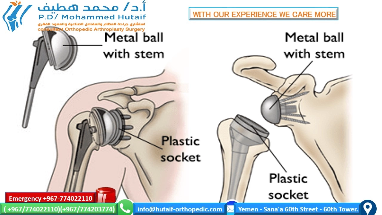 Your risk of developing osteoarthritis of the shoulder with its pain and physical limitations increases with age. But an injury, such as a dislocated shoulder, can lead to shoulder osteoarthritis even in young people. Here is information about the causes of and treatments for shoulder osteoarthritis. Read on to learn how an arthritic shoulder can affect your range of motion and ability to do everyday things, and discover ways to treat and manage the condition. What Is Osteoarthritis? Osteoarthritis -- also known as degenerative joint disease -- occurs when the cartilage that covers the tops of bones, known as articular cartilage, degenerates or wears down. This causes swelling, pain, and sometimes the development of osteophytes -- bone spurs -- when the ends of the two bones rub together. What Is Osteoarthritis of the Shoulder? The shoulder is made up of two joints, the acromioclavicular (AC) joint and the glenohumeral joint. The AC joint is the point where the collarbone, or clavicle, meets the acromion, which is the tip of the shoulder blade. The glenohumeral joint is the point where the top of the arm bone, or humerus, meets the shoulder blade, or scapula. Osteoarthritis is more commonly found in the AC joint. Who Gets Shoulder Osteoarthritis? Osteoarthritis most often occurs in people who are over age 50. In younger people, osteoarthritis can result from an injury or trauma, such as a fractured or dislocated shoulder. This is known as posttraumatic arthritis. Osteoarthritis may also be hereditary. What Are the Symptoms of Shoulder Osteoarthritis? As with most types of osteoarthritis, pain is a key symptom. A person with shoulder arthritis is likely to have pain while moving the shoulder and after moving the shoulder. The person can even have pain while sleeping. Another symptom may be a limited range of motion. This limitation can be seen when you are trying to move your arm. It can also be evident if someone is moving your arm to assess range of motion. Moving the shoulder might also produce a clicking or creaking noise. How Is Shoulder Osteoarthritis Diagnosed? To diagnose shoulder osteoarthritis, the doctor will take a medical history and do a physical exam to assess pain, tenderness, and loss of motion and to look for other signs in surrounding tissues. At this point, the doctor may be able to tell if the muscle near the joint has signs of atrophy, or weakness, from lack of use. Tests that might be ordered to diagnose osteoarthritis of the shoulder include: X-rays Blood tests, mainly to look for rheumatoid arthritis, but also to exclude other diseases Removal of synovial fluid, the lubricating fluid in the lining (synovium) of the joint, for analysis MRI scans How Is Osteoarthritis of the Shoulder Treated? The first treatments for osteoarthritis, including osteoarthritis of the shoulder, do not involve surgery. These treatments include: Resting the shoulder joint. This could mean that the person with arthritis has to change the way they move the arm while performing the activities of daily living. For example, the person might wear clothing that zips up the front instead of clothing that goes over the head. Or the person might prop up hair dryers instead of holding them up for long periods of time. Taking over-the-counter nonsteroidal anti-inflammatory drugs, such as ibuprofen or aspirin. These drugs, also called NSAIDS, will reduce inflammation and pain. Check with your doctor to make sure you can take these drugs safely. Performing physical therapy as assigned by the doctor. Performing range-of-motion exercises. These exercises are used as an attempt to increase flexibility. Applying moist heat. Applying ice to the shoulder. Ice is applied for 20 minutes two or three times a day to decrease inflammation and pain. Using other medications prescribed by the doctor. These might include injections of corticosteroids, for example. Taking the dietary supplements glucosamine and chondroitin. Many people claim relief with these supplements. Evidence is conflicting as to whether they really help. You should discuss using these with your doctor because the supplements may interact with other drugs. If nonsurgical treatments do not work effectively, there are surgeries available. As with any surgery, there are certain risks and potential complications, including infection or problems with anesthesia. Surgical treatments include: Shoulder joint replacement (total shoulder arthroplasty). Replacing the whole shoulder with an artificial joint is usually done to treat arthritis of the glenohumeral joint. Replacement of the head of the humerus, or upper arm bone (hemiarthroplasty). This option, too, is used to treat arthritis of the glenohumeral joint. Removal of a small piece of the end of the collarbone (resection arthroplasty). This option is the most common surgery for treating arthritis of the AC joint and associated rotator cuff problems. After the removal of the end of the bone, the space fills with scar tissue. Show Sources