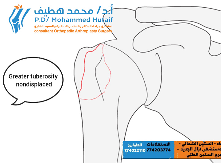  Extra Articular 2-Part, Greater Tuberosity, Non Displaced