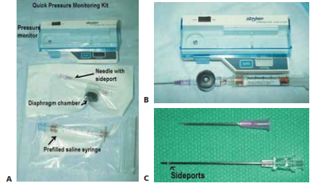FIG 2 • Stryker intracompartmental pressure monitor. A. Quick pressure monitoring kit containing the intracompartmental pressure monitor, a prefilled saline syringe, a diaphragm chamber (transducer), and a needle. B. The assembled pressure monitor. To assemble the monitor kit, the needle is attached to the tapered end of the tapered chamber stem (transducer). The blue cap from the prefilled syringe is removed and the syringe is screwed into the remaining end of the transducer, which is a Luer-lock connection. The cover of the monitor is opened. The transducer is placed inside the well (black surface down). The snap cover is closed. Next, the clear end cap is pulled off the syringe end, and the monitor is ready to use. To prime the monitor, the needle is held at 45 degrees up from the horizontal and the syringe plunger is pushed slowly to purge air from the syringe. The monitor is then turned on. The assembled monitor is tilted at the approximate intended angle of insertion of the needle into the skin. The zero button is pressed to zero the display. The needle is then inserted into the appropriate location in the compartment. C. The intracompartmental pressure monitor needle has side ports to prevent soft tissue from collapsing around the needle opening. This is different from a regular needle that has only one opening at the end.
