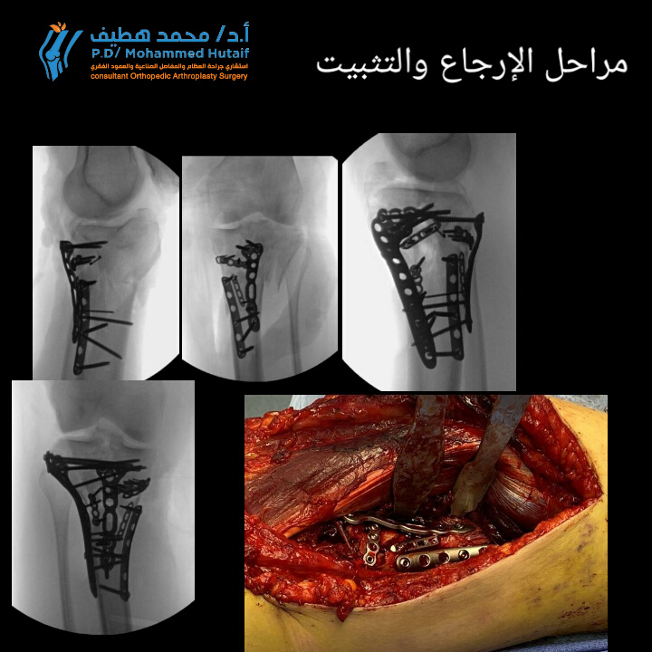أفضل دكتور عظام