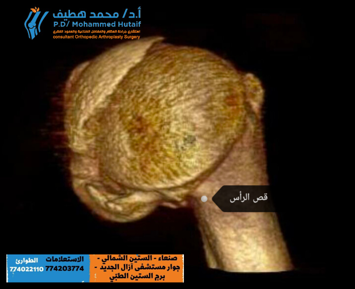 أفضل دكتور عظام