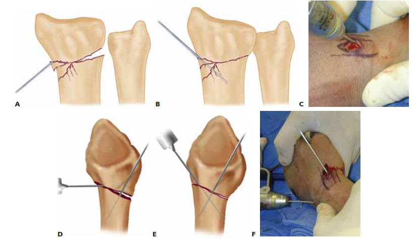 A. An incision is made over the radial styloid and a K-wire is manually inserted into the fracture site. B. The wire is levered distally to correct the radial inclination. C. The wire is advanced proximally, using power, into cortical bone. D. An incision is made over Lister’s tubercle, and a wire is inserted into the fracture site. E,F. The wire is levered distally to correct the dorsal angulation and advanced proximally using power into cortical bone.