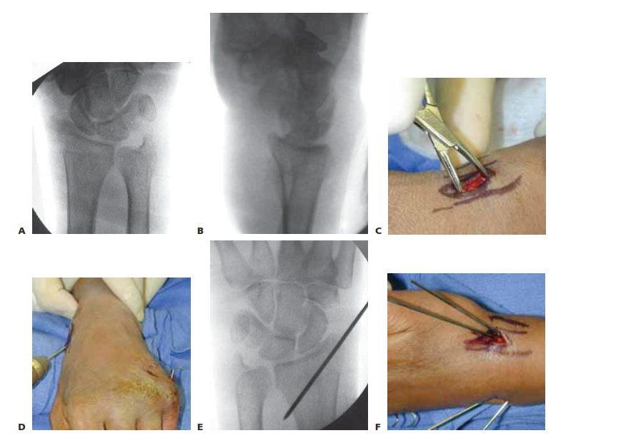 A,B. PA and lateral views demonstrating reduction of distal radius fracture. C. The incision is made over the radial styloid. D. A pin is inserted retrograde into the radial styloid. E. PA radiograph demonstrating the course of the radial styloid wire. F. Two radial styloid wires and two dorsoulnar wires are in place. (continued)