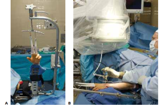 FIG 2 • A. This traction tower (Acumed, Hillsboro, OR) uses a suspension bar at the side rather than at the center of the wrist. This allows easy fluoroscopic evaluation of the fracture reduction, with simultaneous full access to the volar and dorsal aspects of the wrist. B. The tower can be flexed intoa horizontal position for surgeons who prefer to
