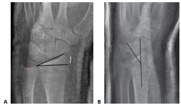 FIG 2 • A. PA radiograph demonstrating radial inclination, (black lines), ulnar variance (red), and radial height (white bracket). 8. Lateral radi- ograph of the wrist demonstrating volar tilt (black lines).