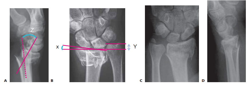 FIG 3 • PA radiograph (A) and lateral radiograph (B) of a healed distal radius fracture fixed with an intramedullary plate. C,D. PA and lateral radiographs showing an unstable metaphyseal distal radius fracture. (C,D: copyright Thomas R. Hunt III, MD.)