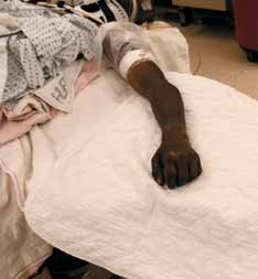 FIG 4 • Patient is positioned supine with arm on a hand table and tourniquet applied on proximal arm