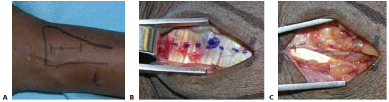 TECH FIG 1 • A. Skin incision is drawn in relation to the tubercle of Lister. B. Skin incision is carried down to extensor reti- naculum. Tubercle of Lister and retinacular incision are drawn. C. The retinaculum is incised and the EPL tendon is exposed. Hematoma has already been evacuated. (continued)