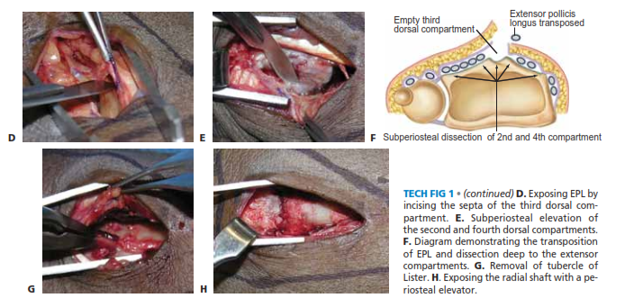TECH FIG 1 • (continued) D. Exposing EPL by incising the septa of the third dorsal com- partment. E. Subperiosteal elevation of the second and fourth dorsal compartments. F. Diagram demonstrating the transposition of EPL and dissection deep to the extensor compartments. G. Removal of tubercle of Lister. H. Exposing the radial shaft with a pe- riosteal elevator.