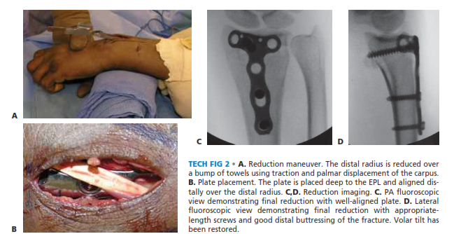 TECH FIG 2 • A. Reduction maneuver. The distal radius is reduced over a bump of towels using traction and palmar displacement of the carpus. B. Plate placement. The plate is placed deep to the EPL and aligned dis- tally over the distal radius. C,D. Reduction imaging. C. PA fluoroscopic view demonstrating final reduction with well-aligned plate. D. Lateral fluoroscopic view demonstrating final reduction with appropriate- length screws and good distal buttressing of the fracture. Volar tilt has