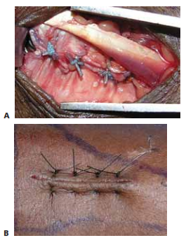 TECH FIG 3 • A.  Retinacular closure. The extensor retinaculum is closed deep to the EPL with a nonabsorbable suture. B.  Skin closure. The  skin  is closed with a horizontal mattress stitch toevert the skin edges.                                                                      