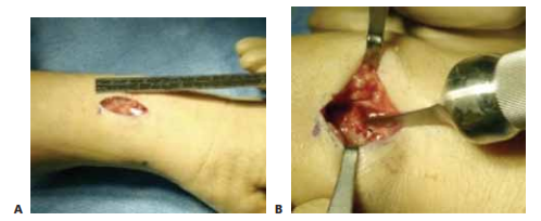 TECH FIG 4 • A.  A 2.5-cm  dorsal incision is used for  exposure. B. The awl  is inserted through the fracture site  after r