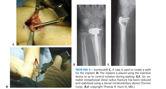 TECH FIG 4 • (continued) C. A rasp is used to create a path for the implant. D. The implant is placed using the insertion device so as to control rotation during seating. E,F. An un- stable metaphyseal distal radius fracture has been reduced and stabilized using a dorsal intramedullary device (TornierCorp). (E,F: copyright Thomas R. Hunt III, MD.)