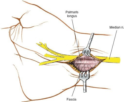 Figure 5-22 The skin is retracted, and the deep fascia and tendon of the palmaris longus are inspected.