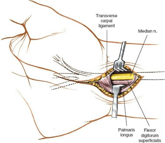 Figure 5-23 The deep fascia is incised. The palmaris longus is retracted toward the ulna, revealing the median nerve as it enters the carpal tunnel.