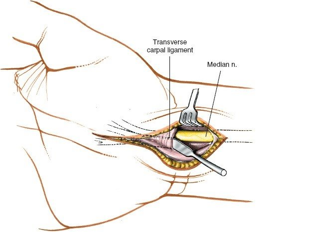 Figure 5-24 A spatula is placed under the transverse carpal ligament to protect the median nerve as the ligament is incised.