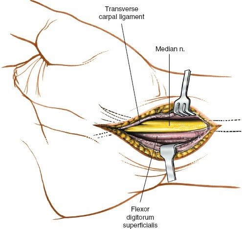 Figure 5-25 The transverse carpal ligament is released on the ulnar side of the nerve to avoid damage to the motor branch of the thenar muscle.