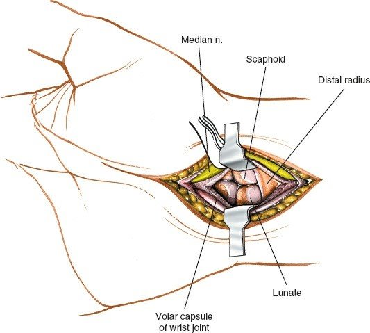 Figure 5-27 Incise the joint capsule to expose the carpus.