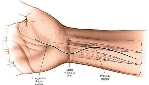 Figure 5-28 Extend the wrist incision proximally to expose the distal forearm and median nerve.
