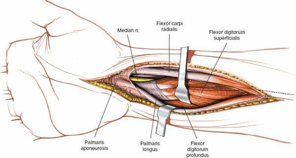 Figure 5-29 Incise the fascia on the forearm between the palmaris longus and the flexor carpi radialis to expose the tendons and muscles of the flexor digitorum superficialis.