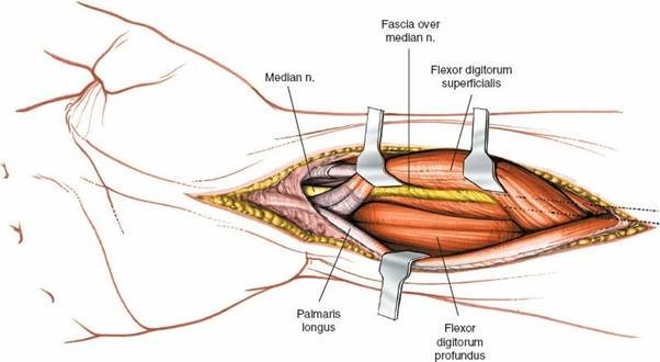 Figure 5-30 Reflect the flexor digitorum superficialis and note that the median nerve moves with it, because it is attached to the muscle via the posterior fascia of the muscle.