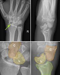 PA view of the wrist
